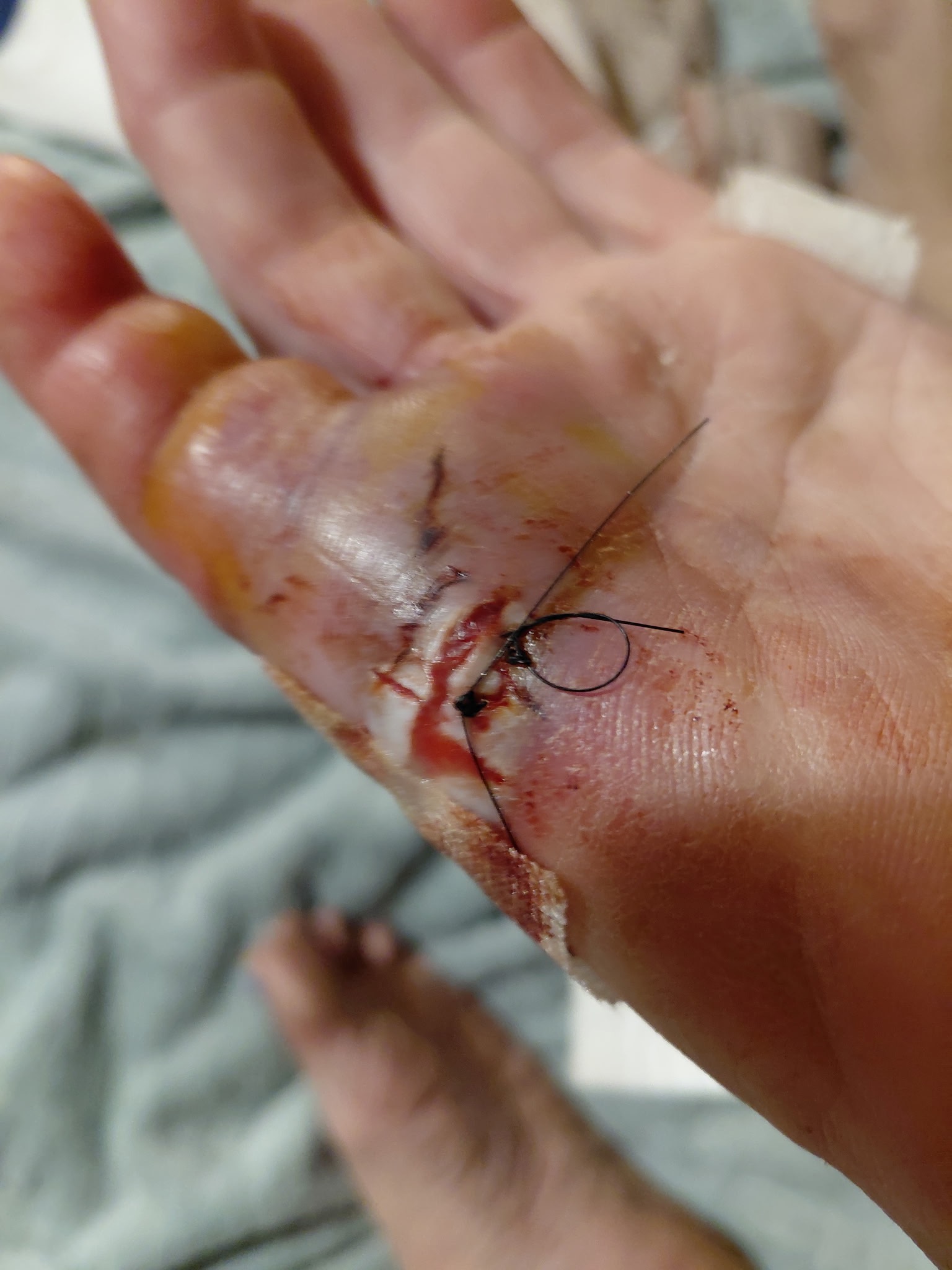 Support Donna's Recovery After Dog Bite campaign photo, 5 of 7