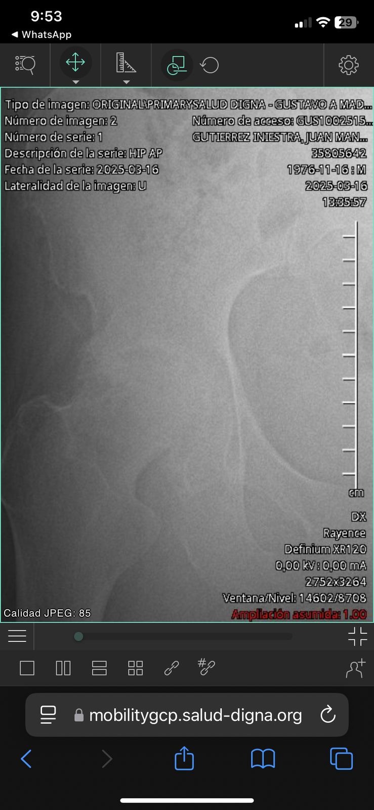 Donar para adquirir mis prótesis de cadera campaign photo, 4 of 8