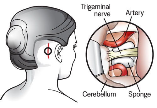 Brain surgery needed for Trigeminal Neuralgia relief. campaign photo, 2 of 4