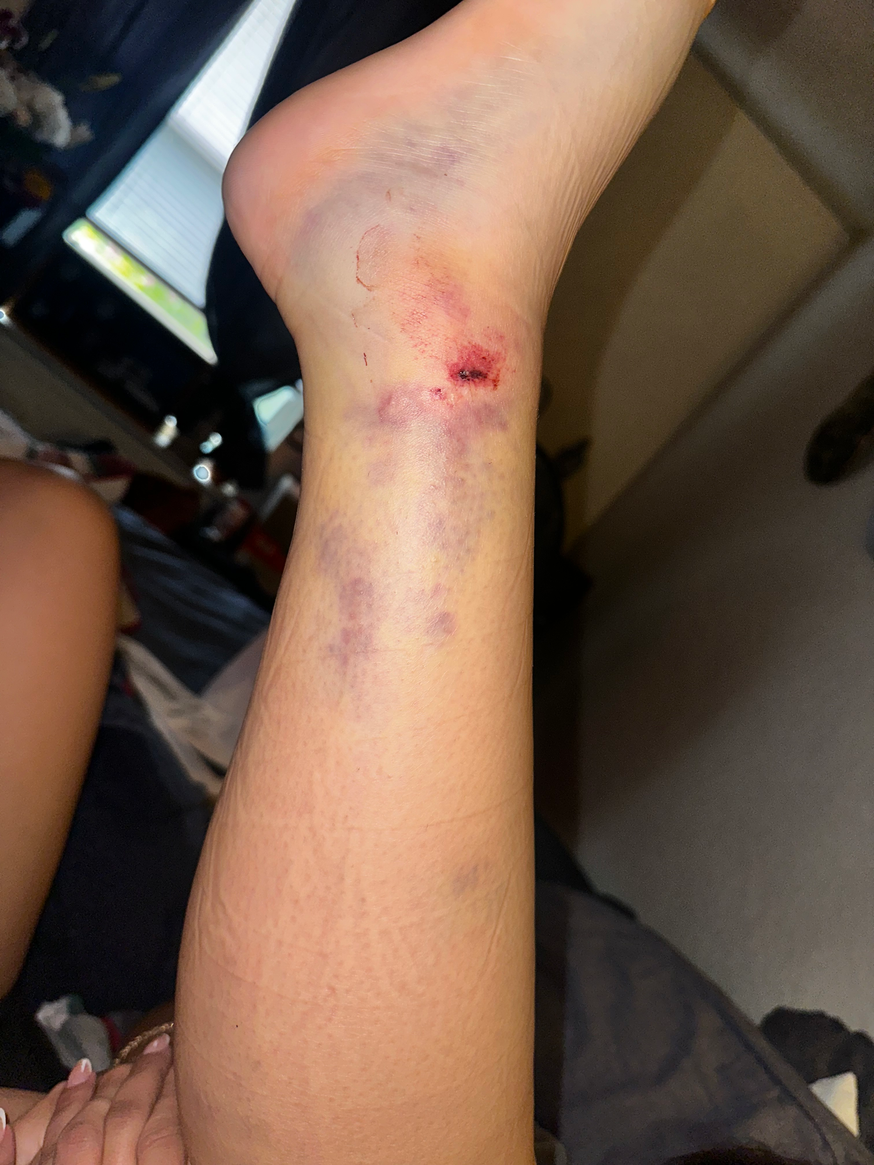 Help Nelisa Get Urgent Ankle Surgery campaign photo, 2 of 6