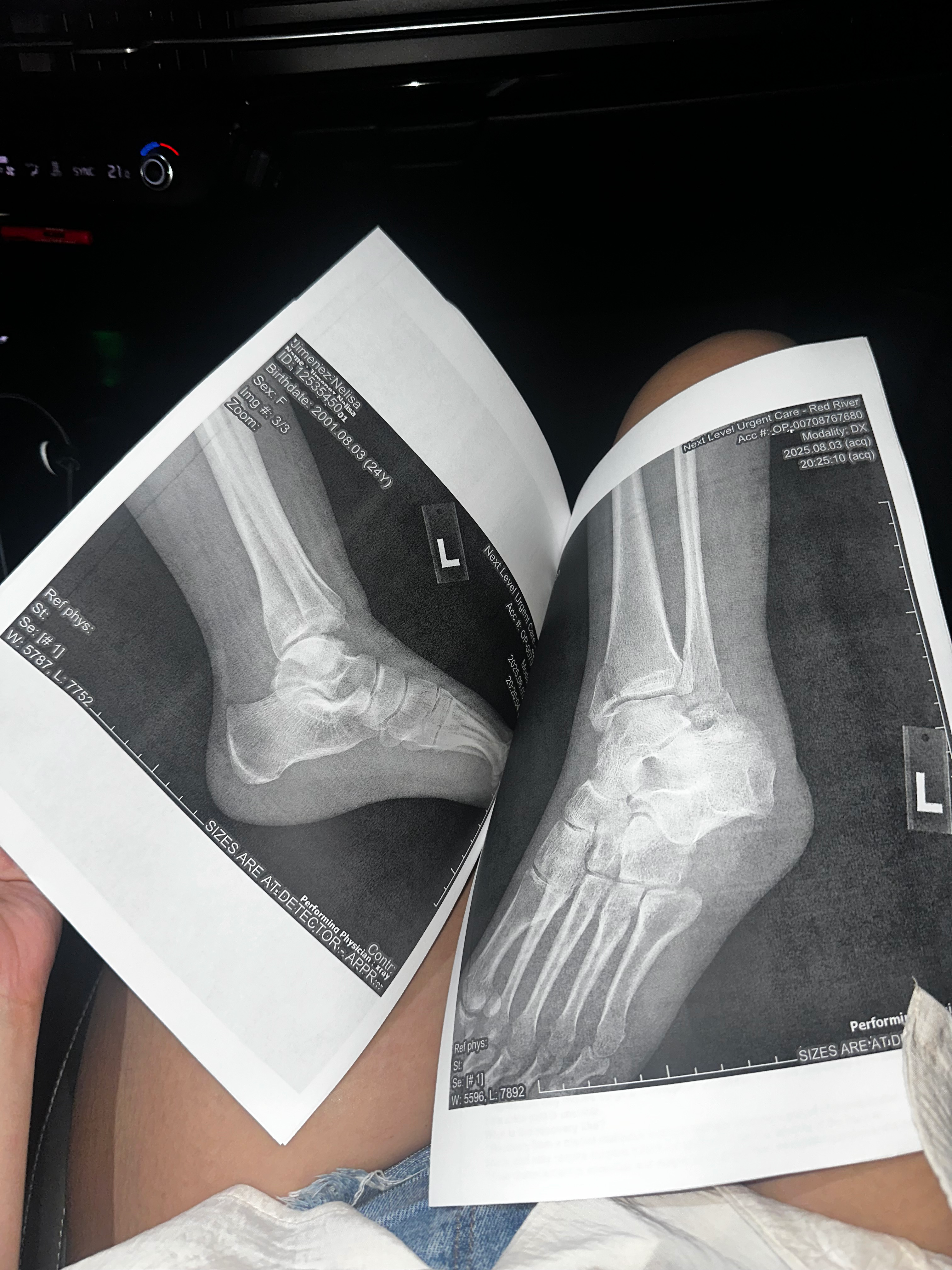 Help Nelisa Get Urgent Ankle Surgery campaign photo, 4 of 6