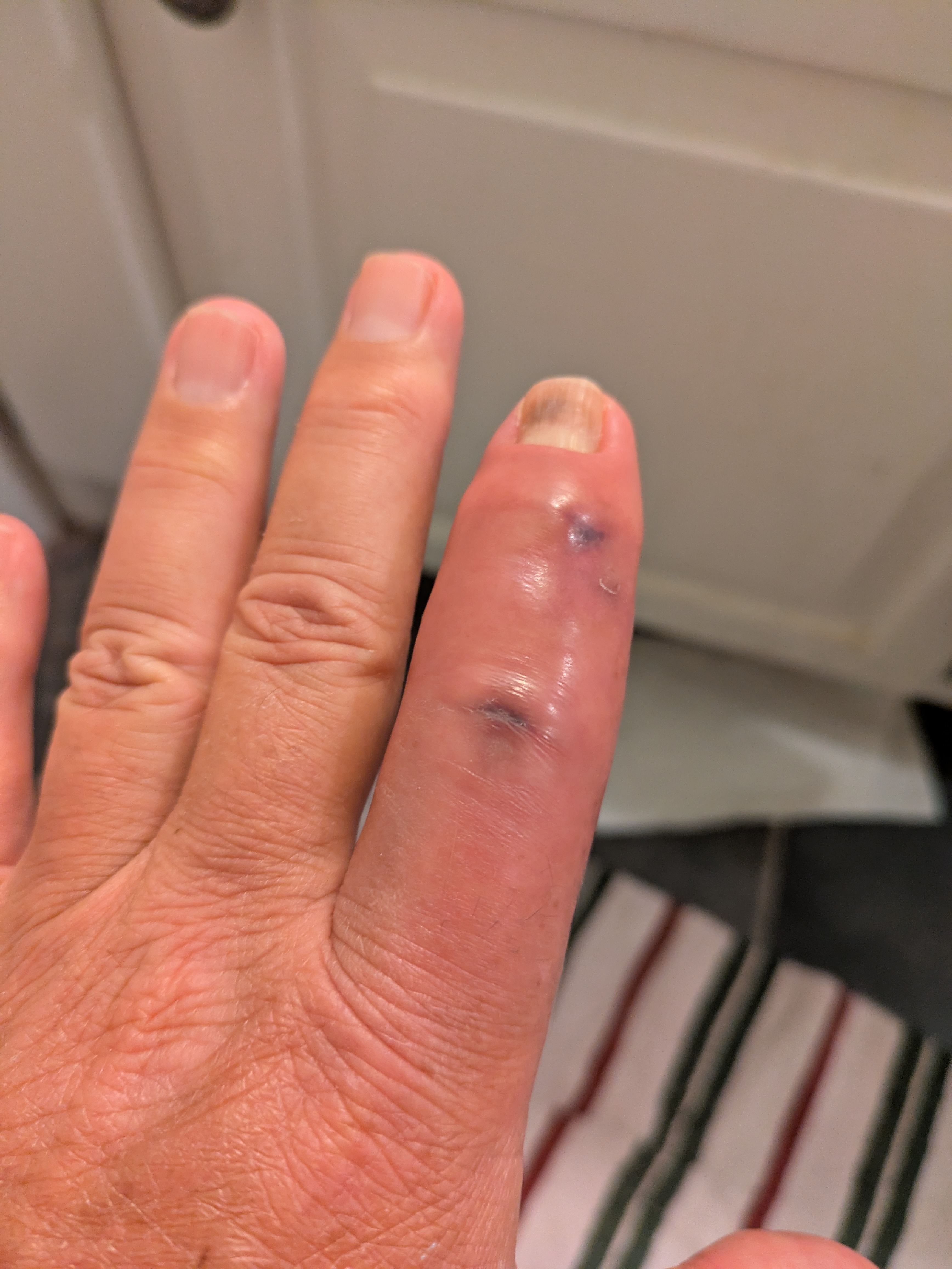 Support Steve’s Recovery After Work Injury campaign photo, 4 of 8