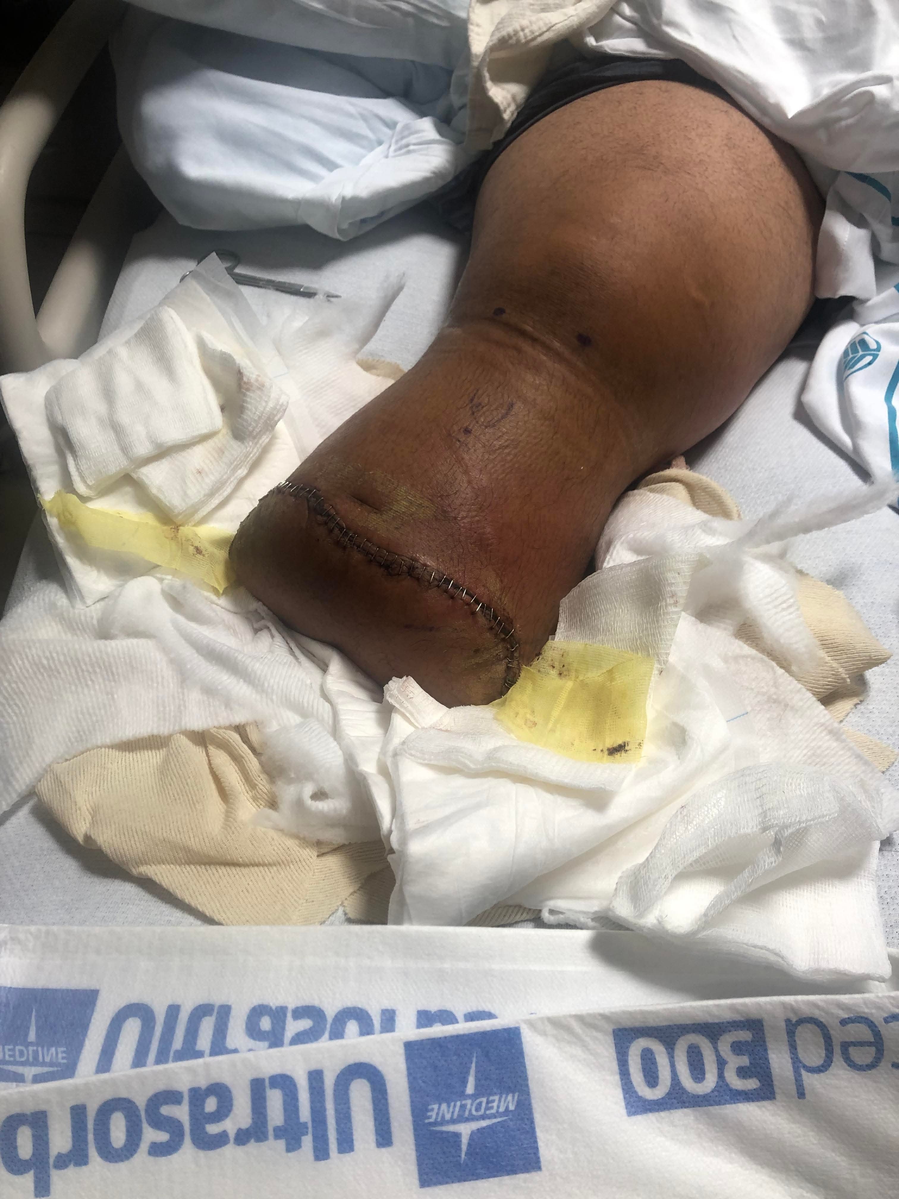Veteran’s Family Crisis: Post Amputation & New Cancer Spread campaign photo, 4 of 8