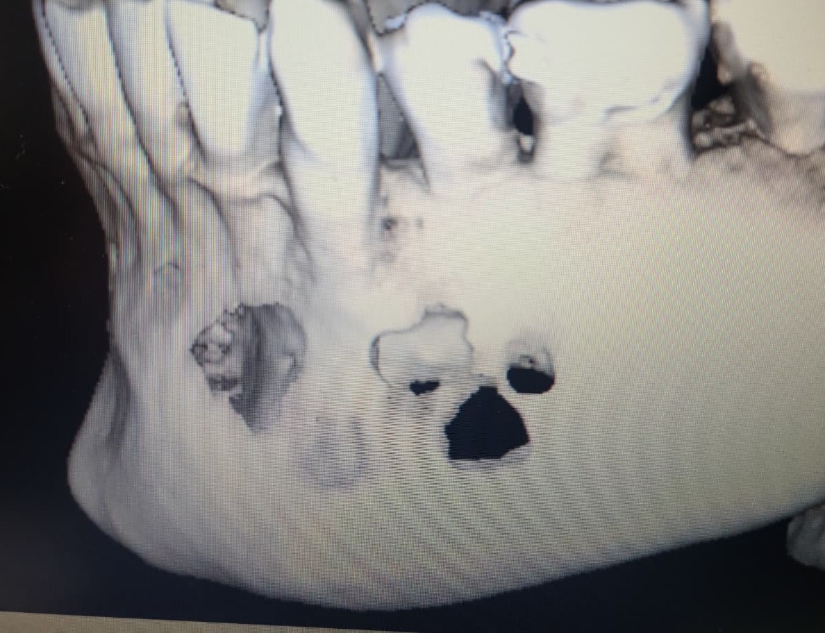 Support Gary's Critical Jaw Surgery in Mexico campaign photo, 5 of 6