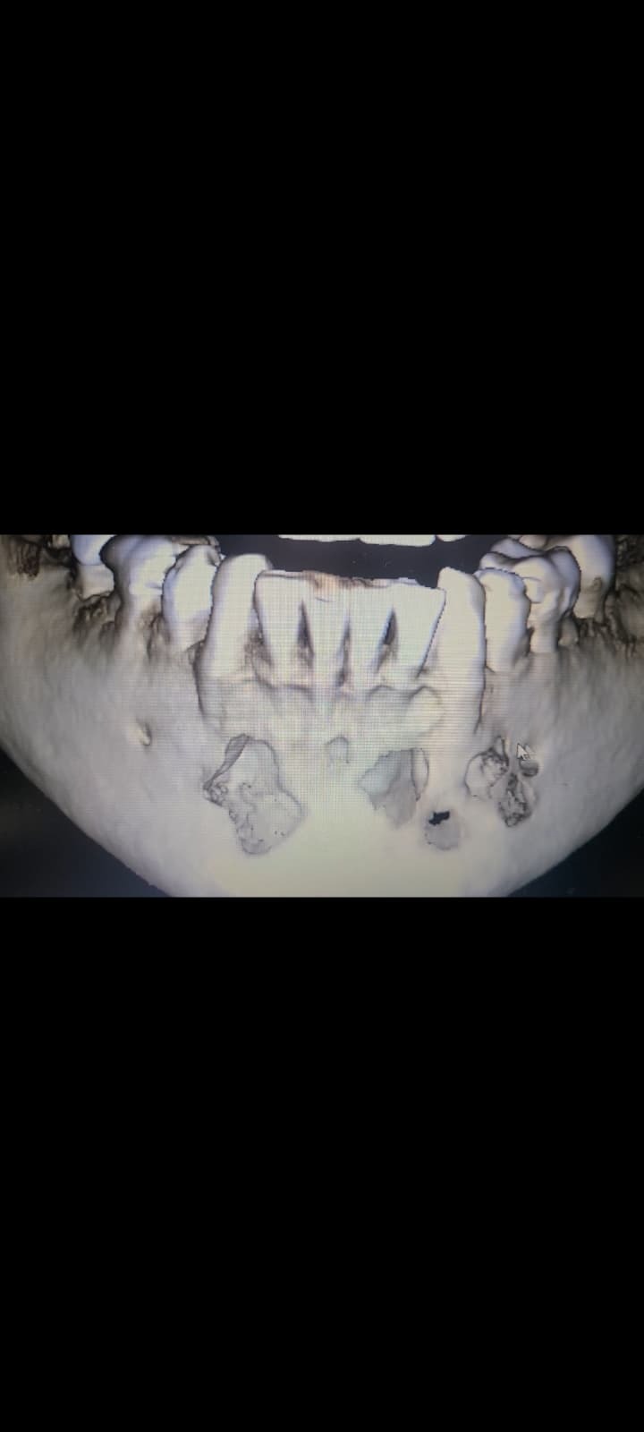 Support Gary's Critical Jaw Surgery in Mexico campaign photo, 2 of 6