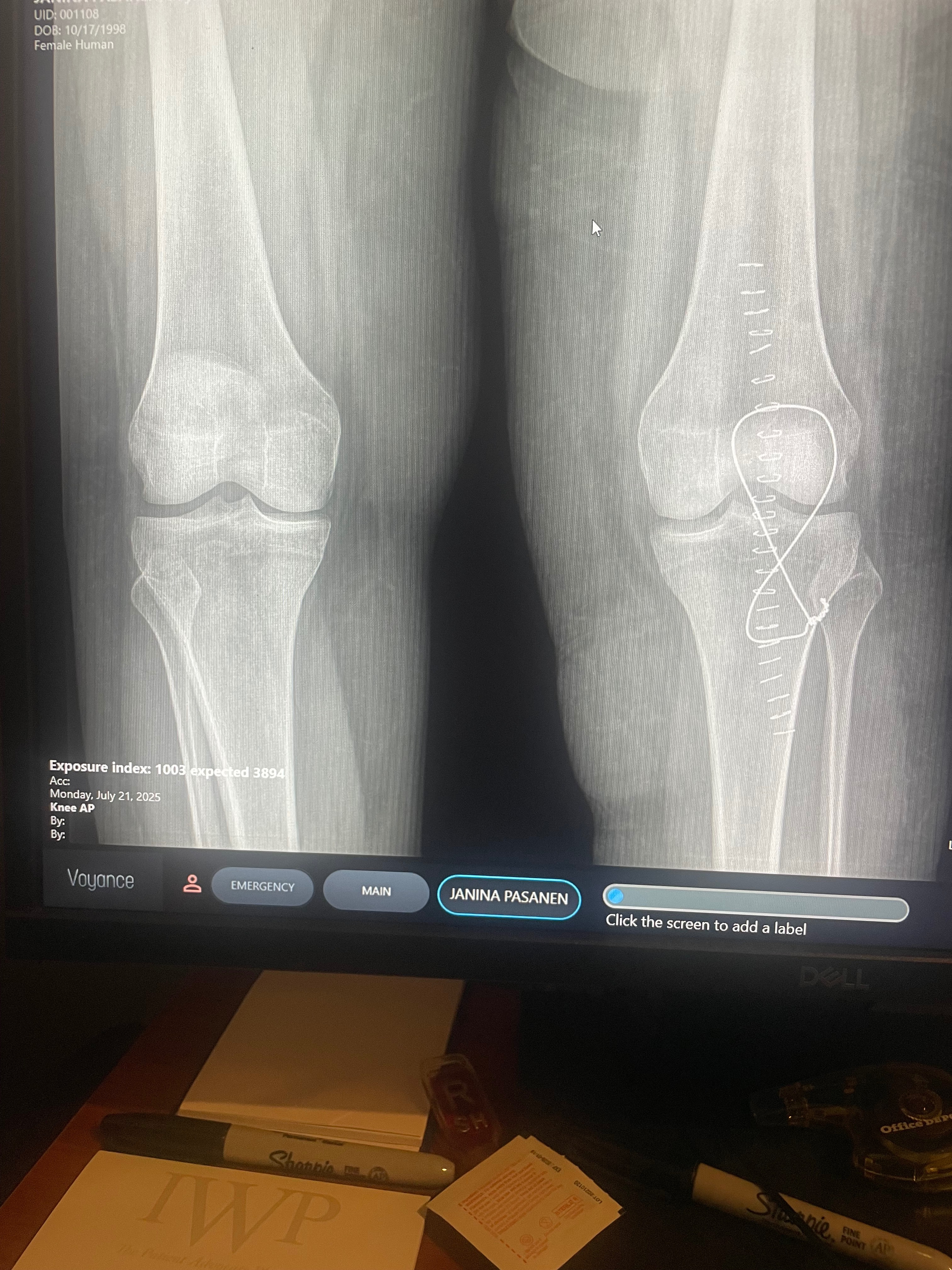 Help Janina Heal and Get Back On Her Feet campaign photo, 2 of 6