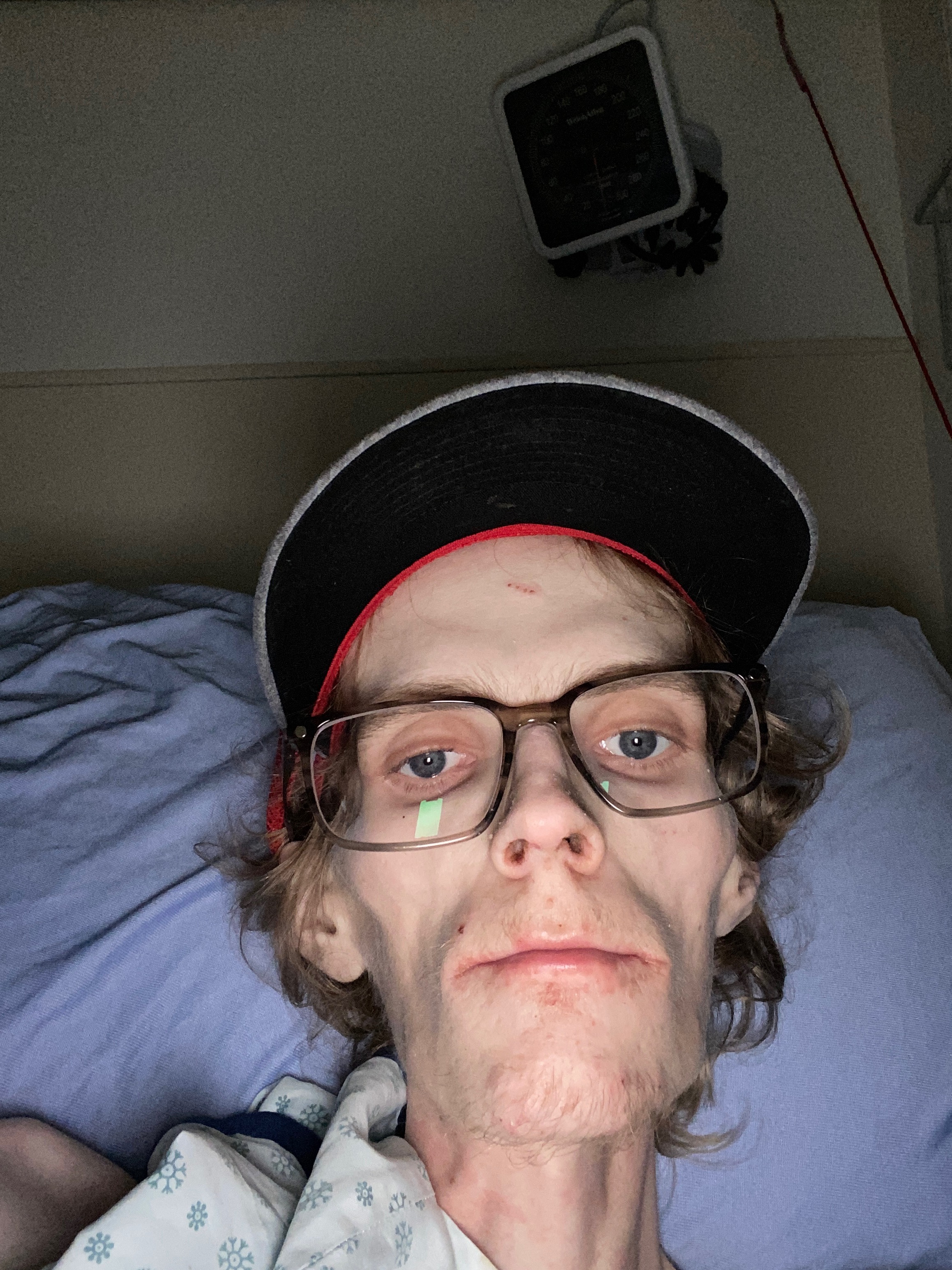 Help Austin Heal, Recover, and Rebuild After Surgery campaign photo, 2 of 4
