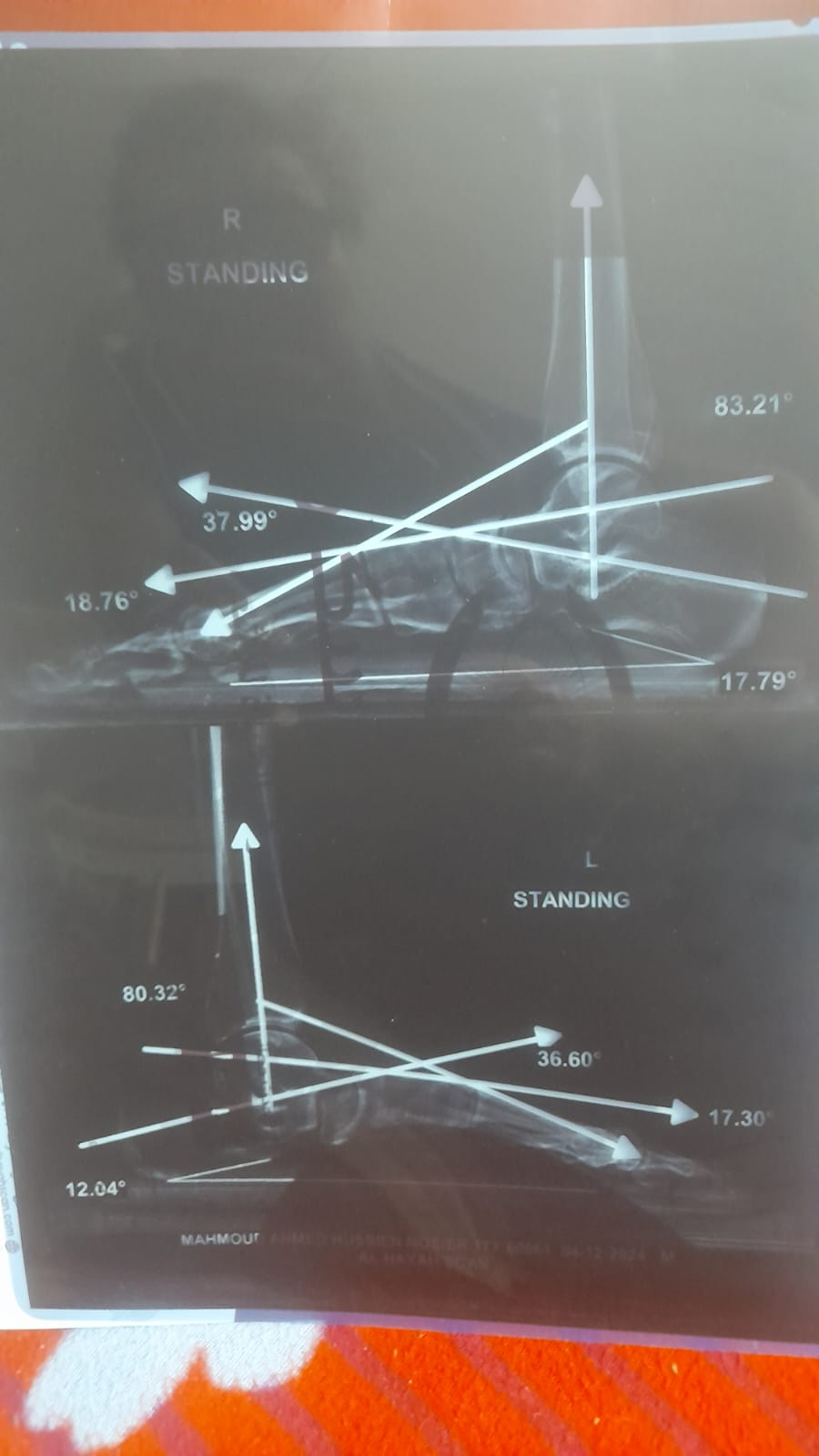 Help Mahmood Walk Again: Urgent Surgery Needed campaign photo, 2 of 6