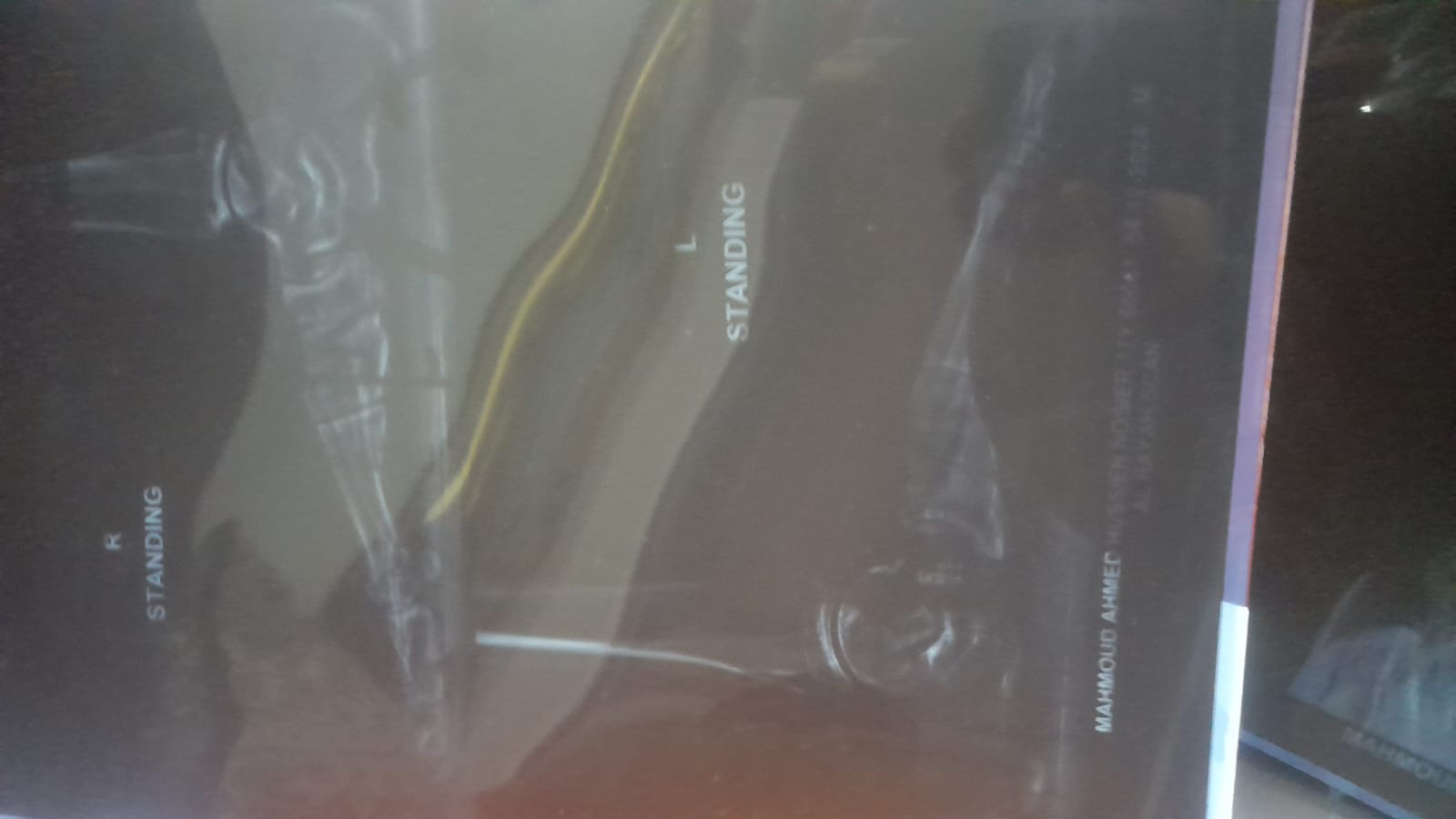 Help Mahmood Walk Again: Urgent Surgery Needed campaign photo, 4 of 6