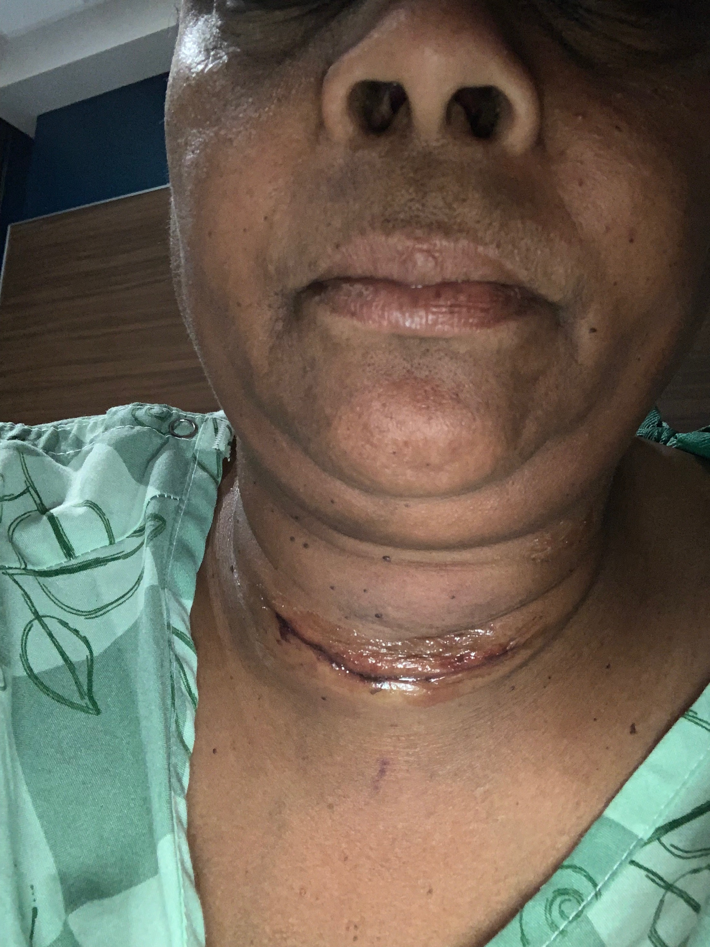 Support Recovery After Thyroid Surgery campaign photo, 7 of 8