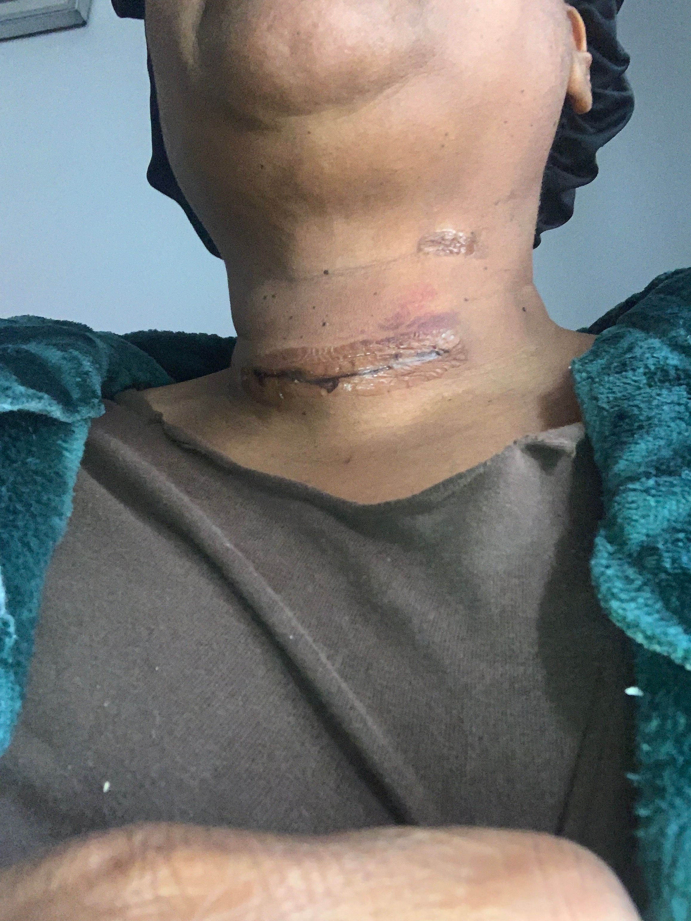 Support Recovery After Thyroid Surgery campaign photo, 5 of 8