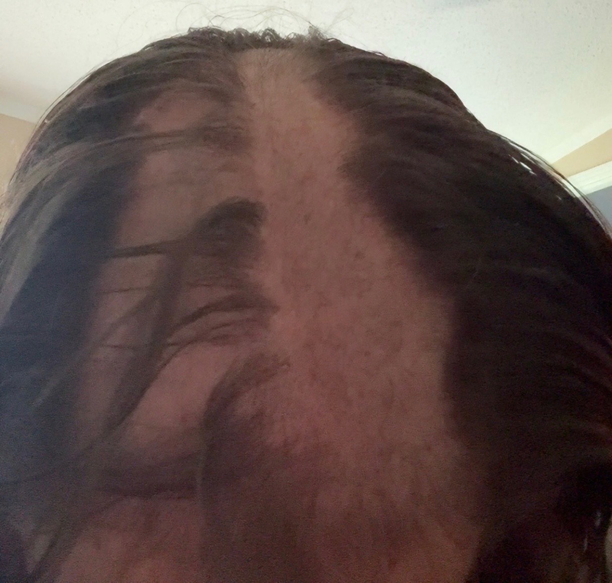 Join Holly in Her Fight Against Hair Loss campaign photo, 4 of 7