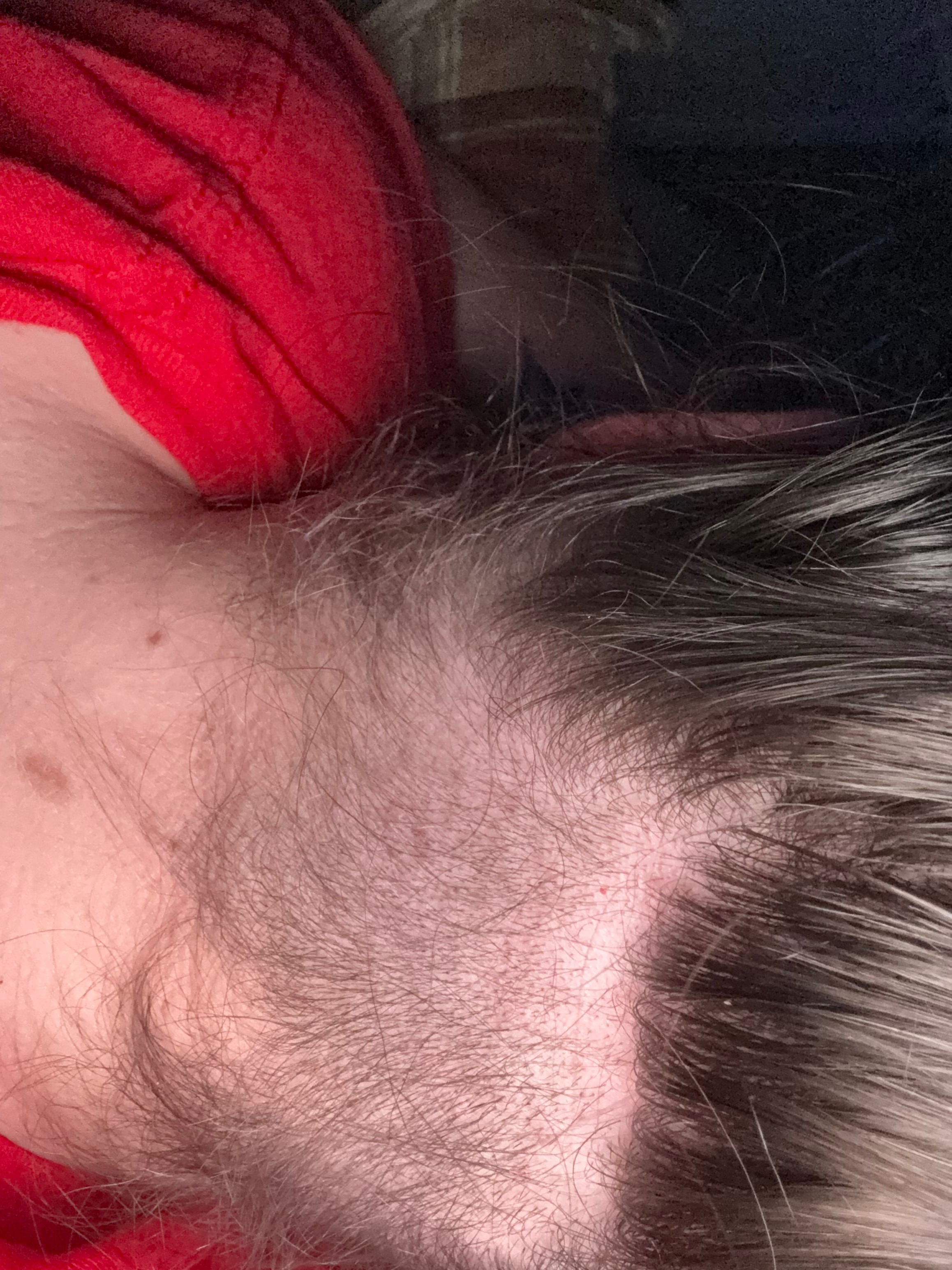 Join Holly in Her Fight Against Hair Loss campaign photo, 5 of 7