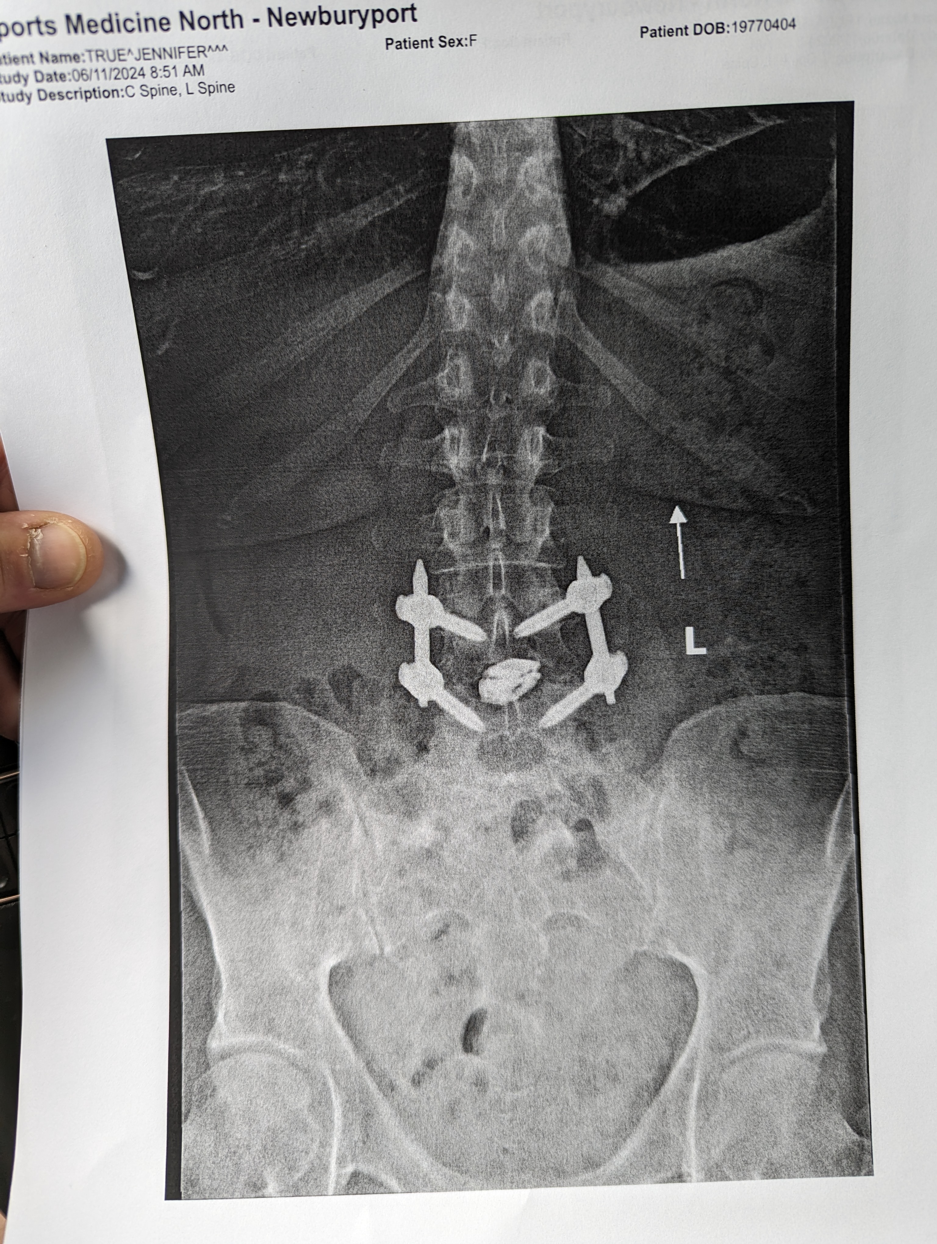 Spinal injury in need of Freedom campaign photo, 6 of 7