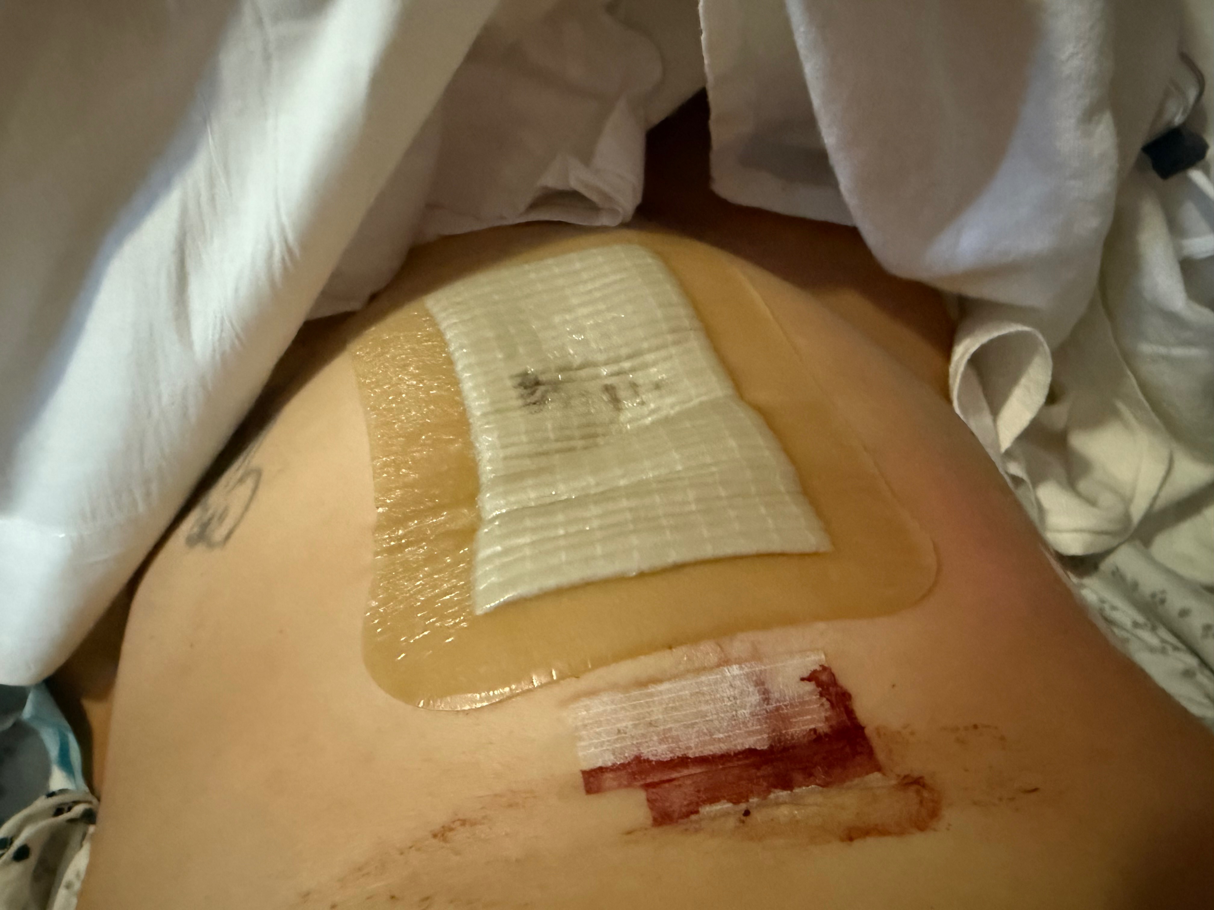 Support Recovery from Diverticulitis Surgery campaign photo, 2 of 8