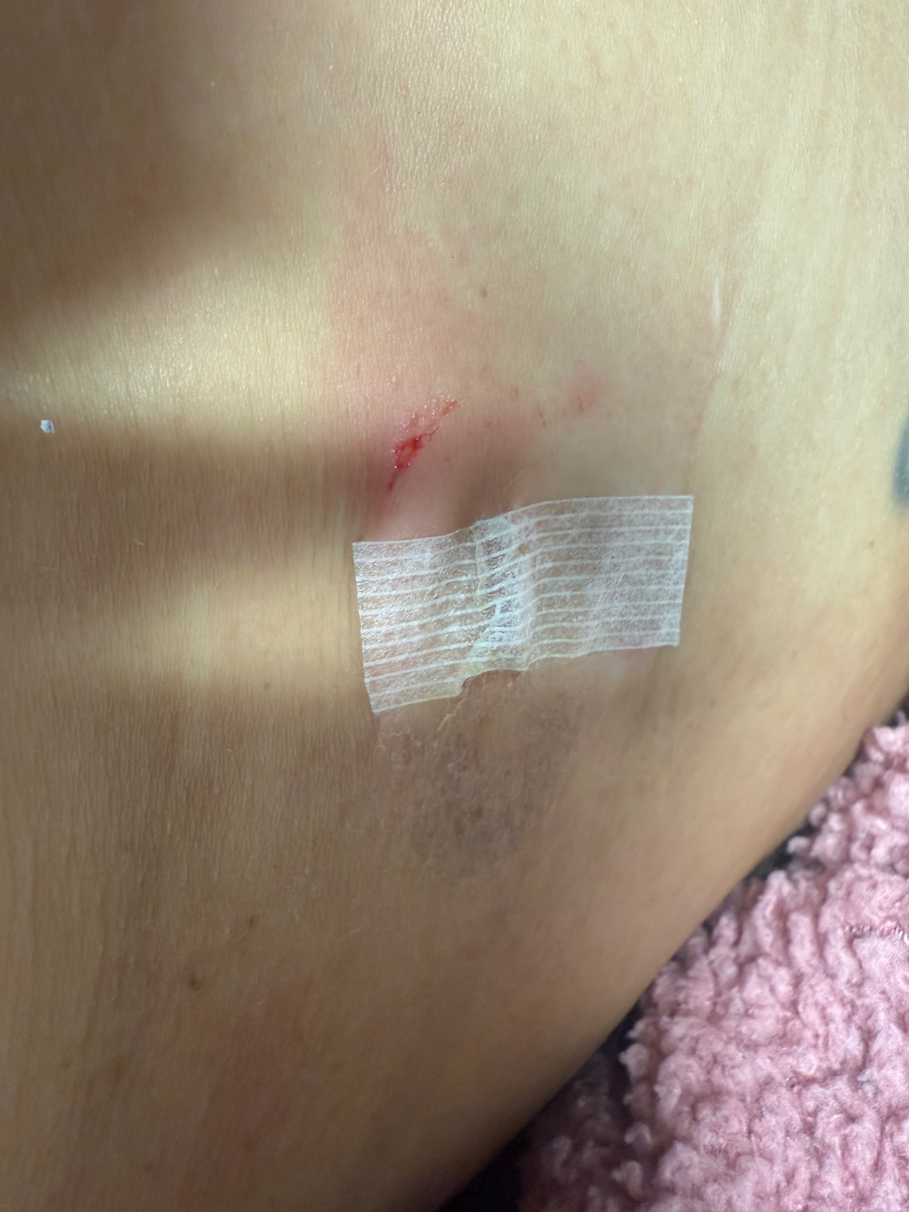 Support Recovery from Diverticulitis Surgery campaign photo, 4 of 8