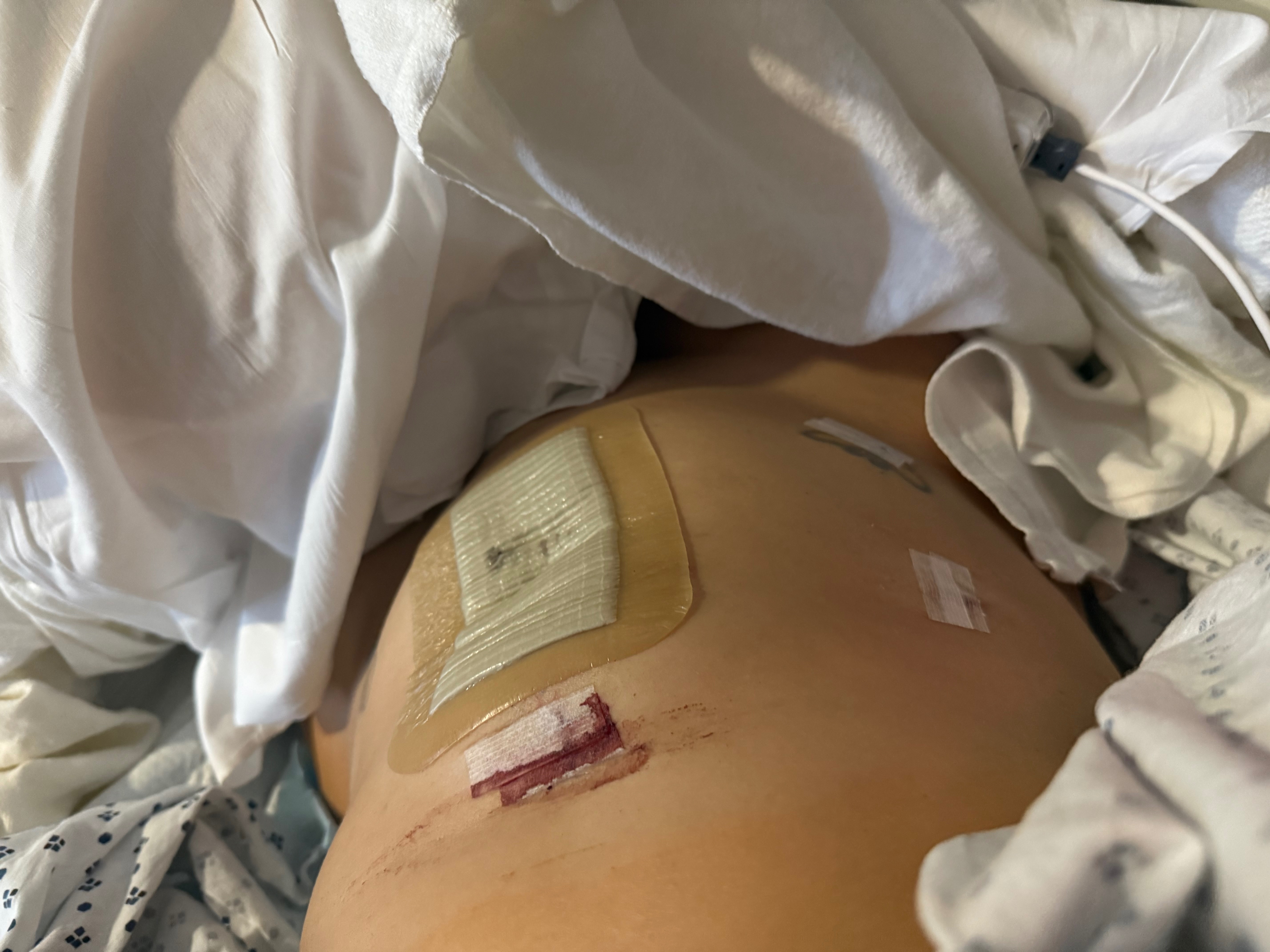 Support Recovery from Diverticulitis Surgery campaign photo, 5 of 8