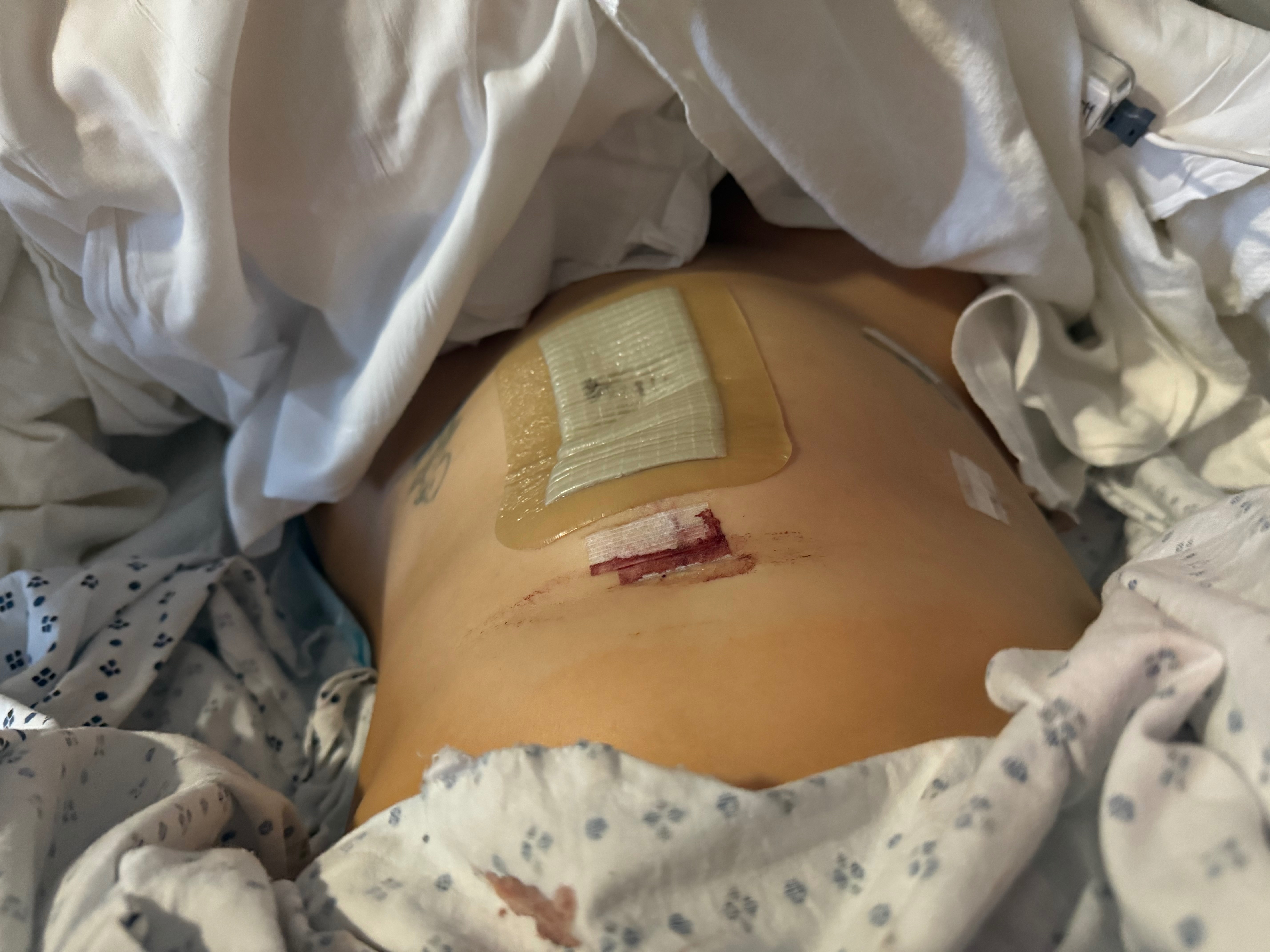 Support Recovery from Diverticulitis Surgery campaign photo, 6 of 8