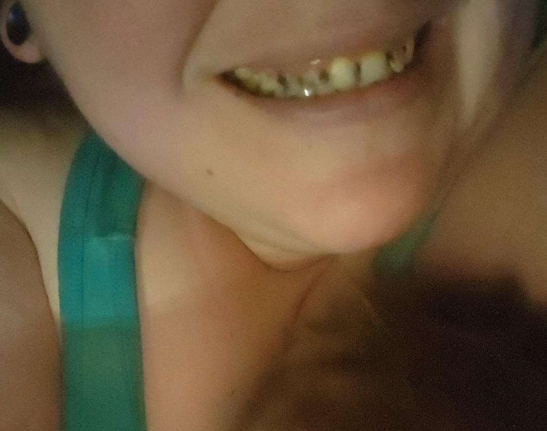 Support Needed for Life-Changing Dentures campaign photo, 4 of 5
