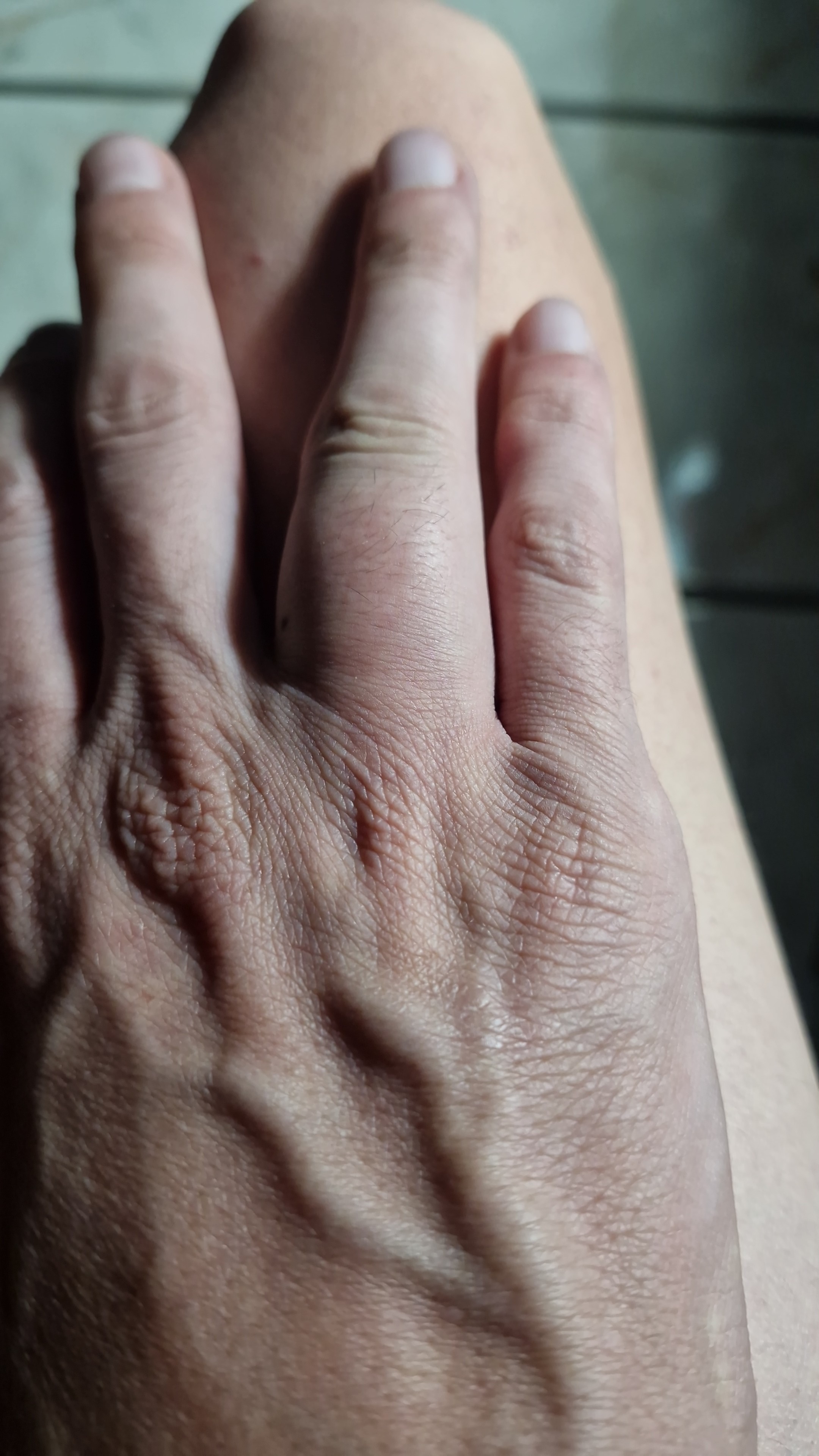 Hola! Tengo un tumor en los huesos de mi mano campaign photo, 7 of 8