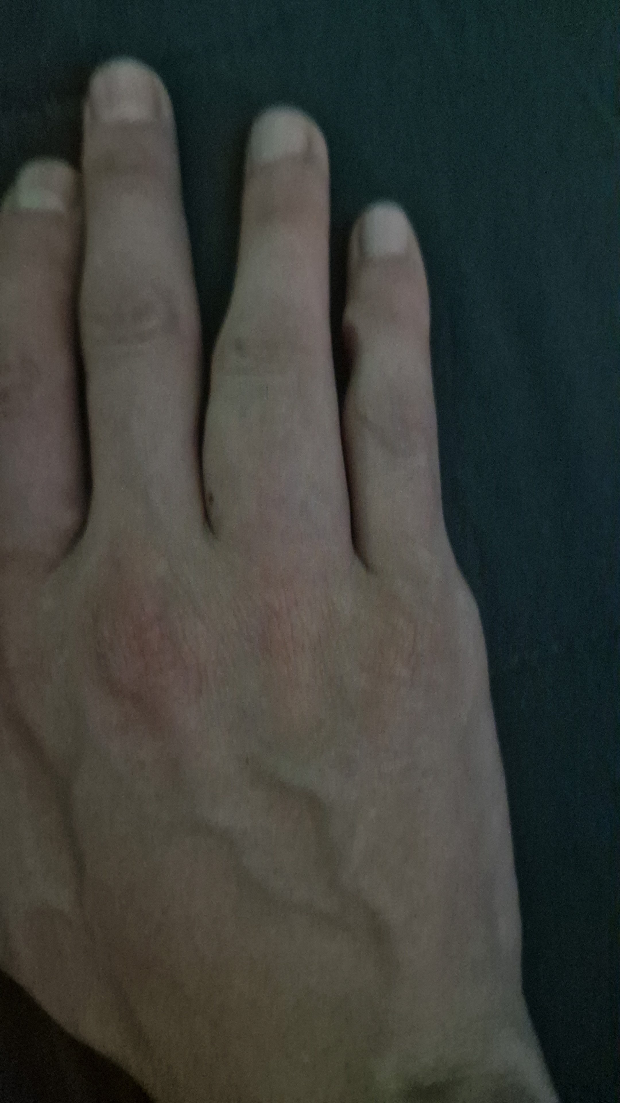 Hola! Tengo un tumor en los huesos de mi mano campaign photo, 2 of 8