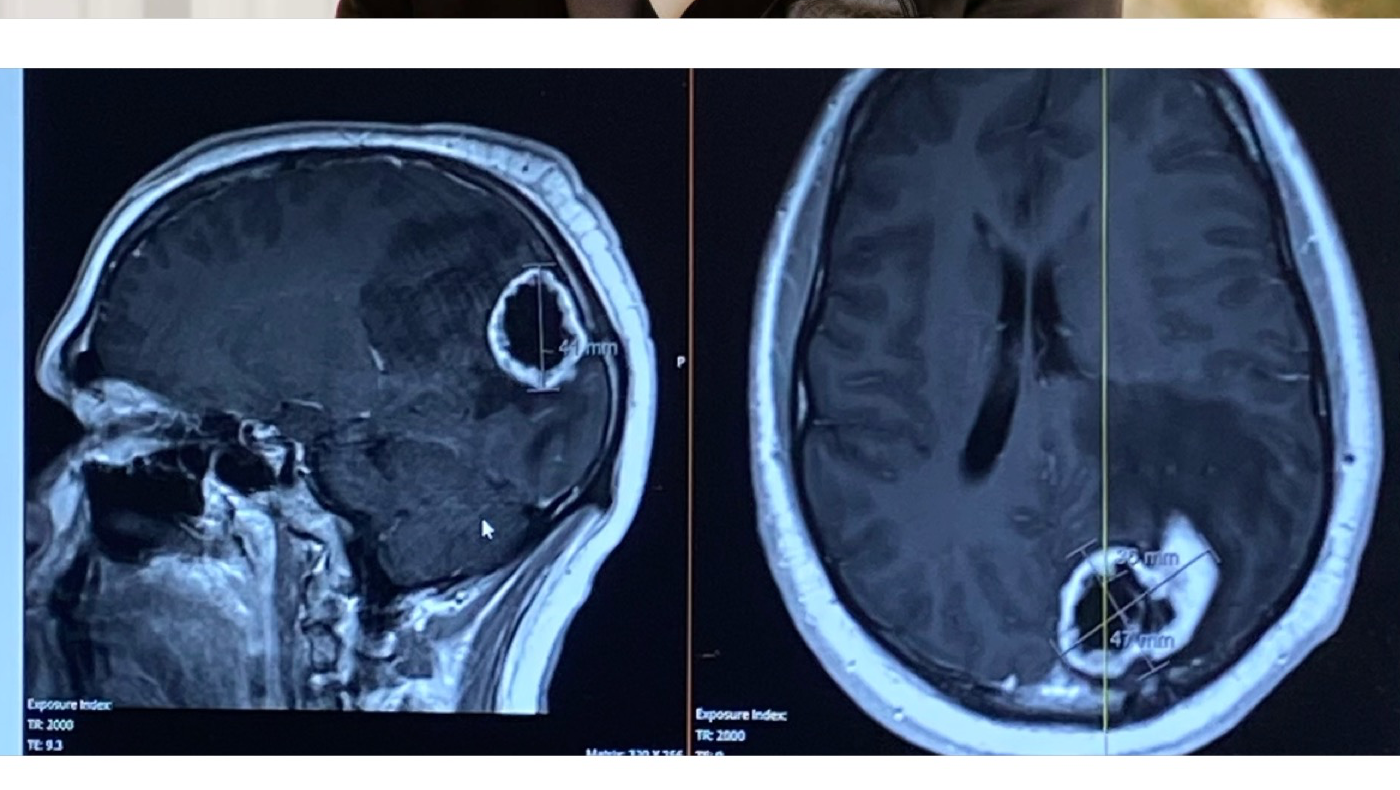 Support Eli's Fight Against Fred the Tumor photo