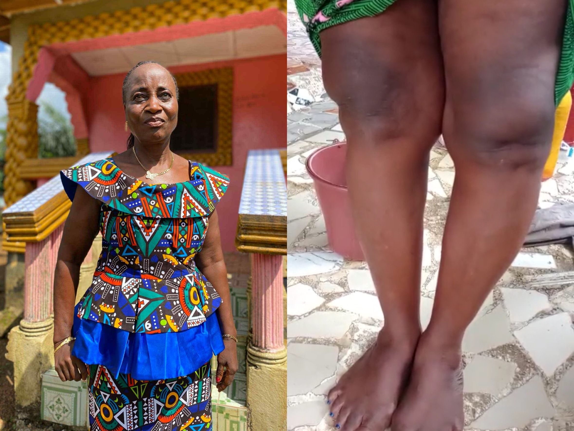 Support Esther Tokpa's Urgent Knee Surgeries campaign photo, 5 of 7