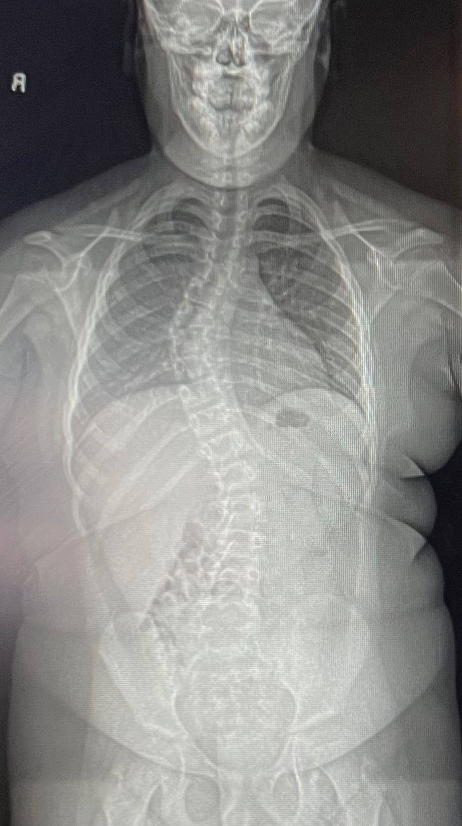 Operación Scoliosis campaign photo, 2 of 5