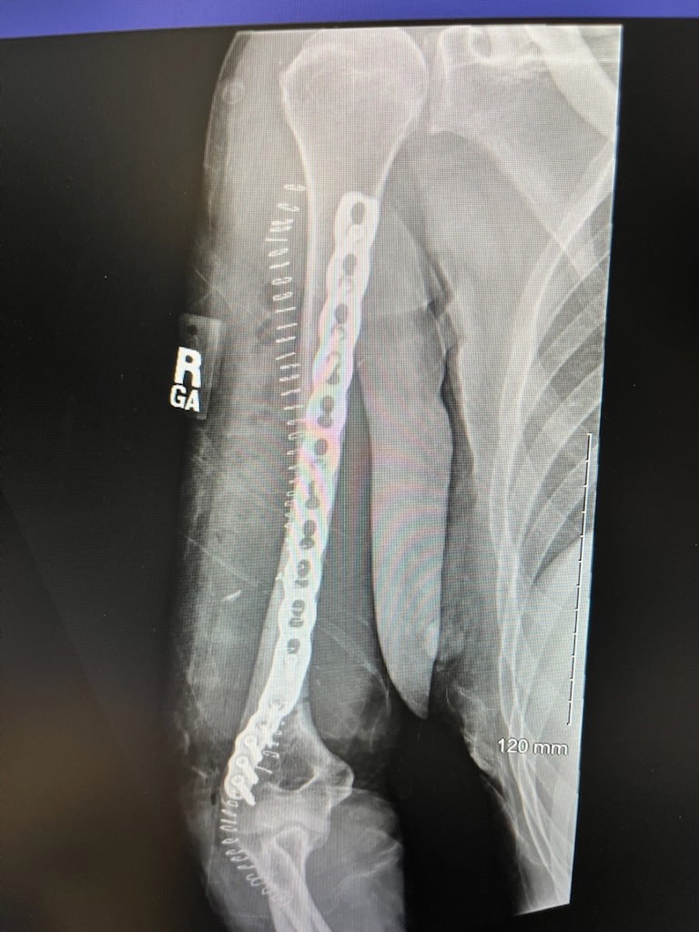 Send love & support - my sister fights to recover campaign photo, 2 of 7