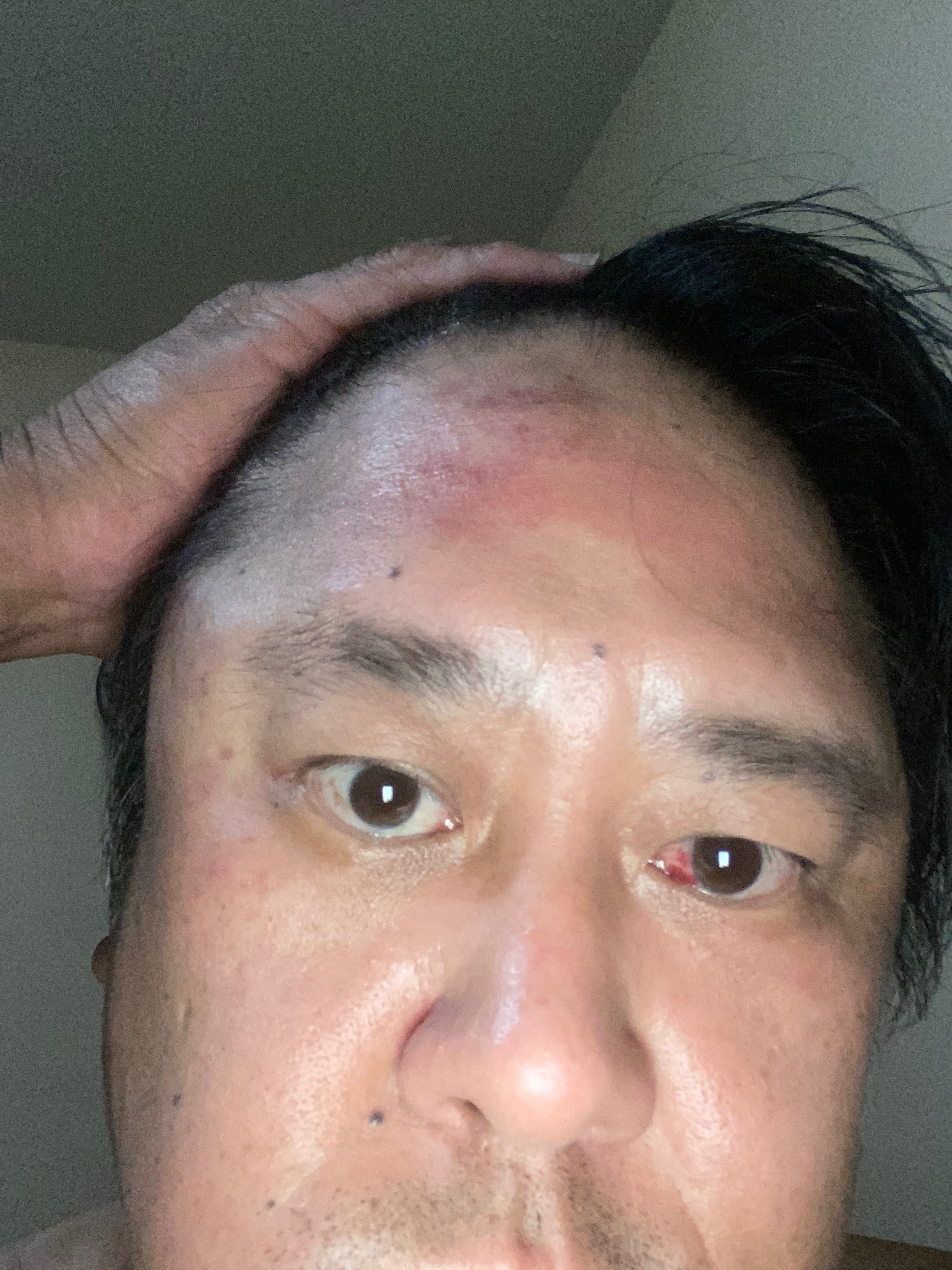 Ryen Needs Help After Being Assaulted campaign photo, 5 of 7