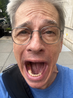 Help Vincent Chew Again — 2 Bridges, 4 Crowns, 4 Abutments campaign photo, 4 of 8