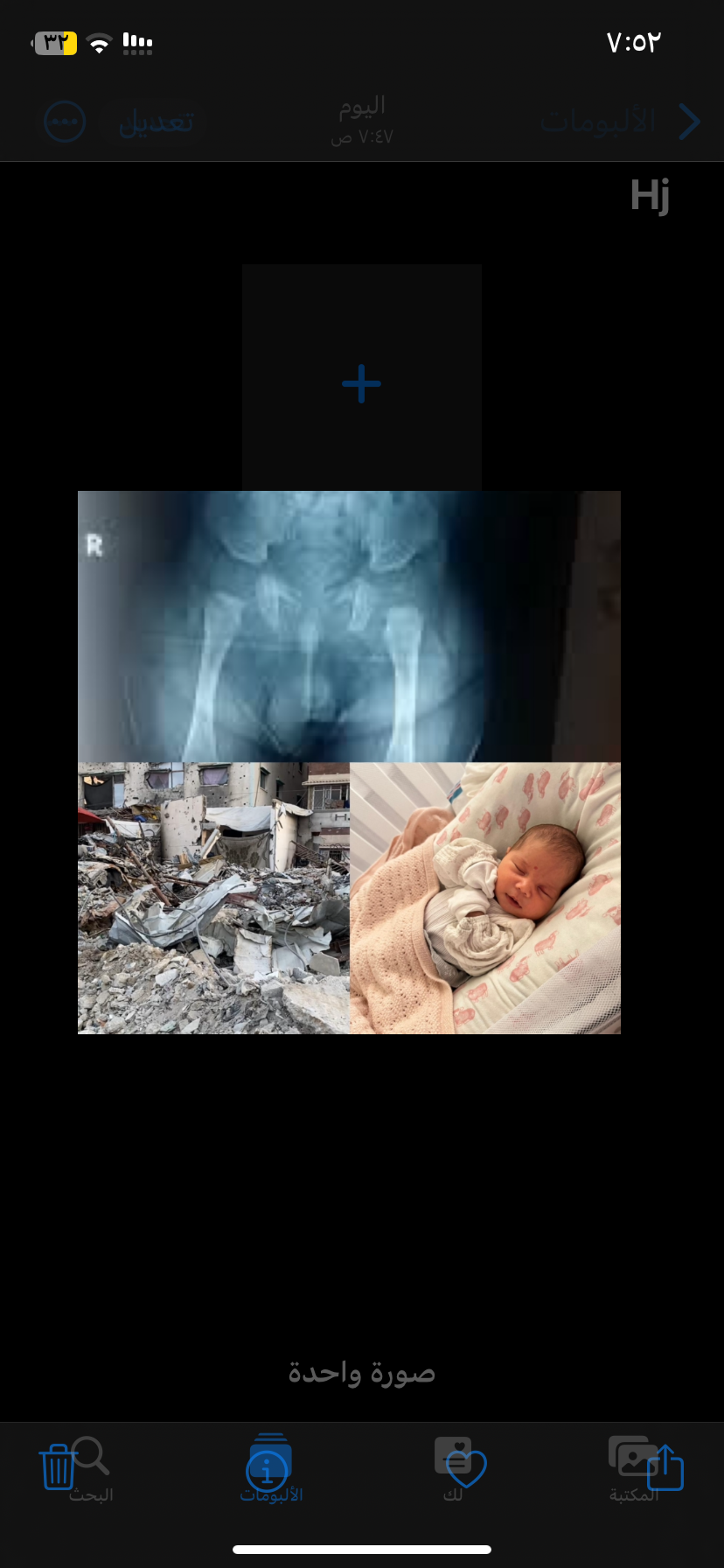Help Orphan Baby in Urgent Need Surgery to walk normally campaign photo, 2 of 4