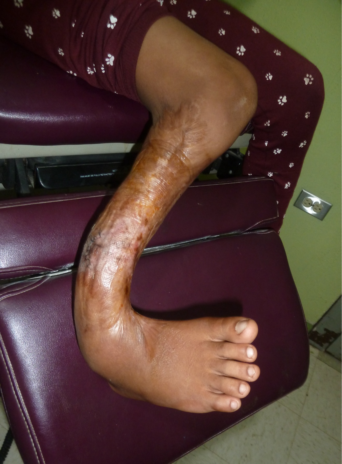 Help Bring Orthopedic Surgery to Children in Guatemala campaign photo, 7 of 8