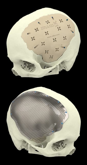 Placa Craneal campaign photo, 4 of 5