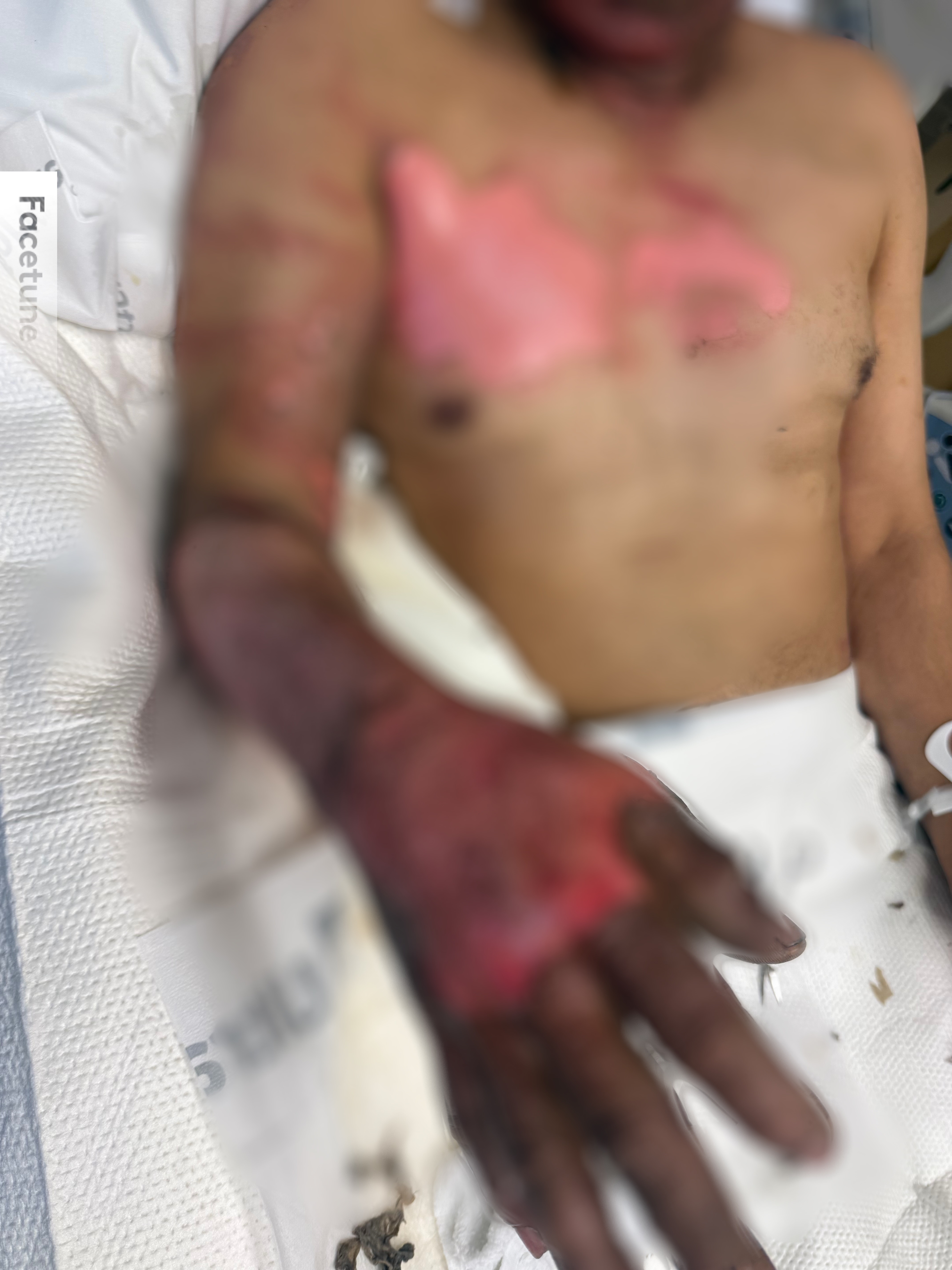 Support Humberto's Recovery from Severe Burns campaign photo, 6 of 8