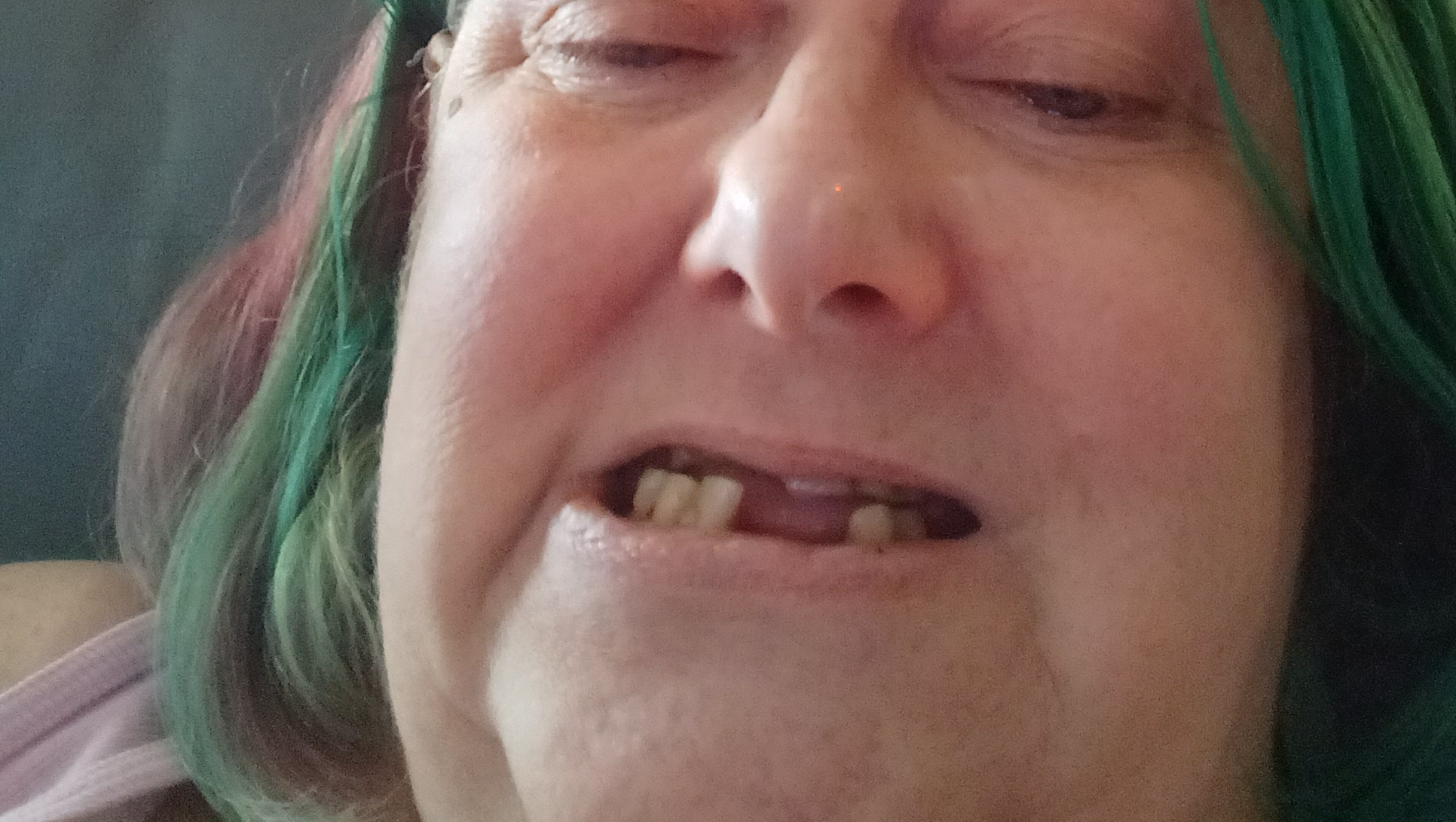 Dentures for Shannon: A Vital Need photo