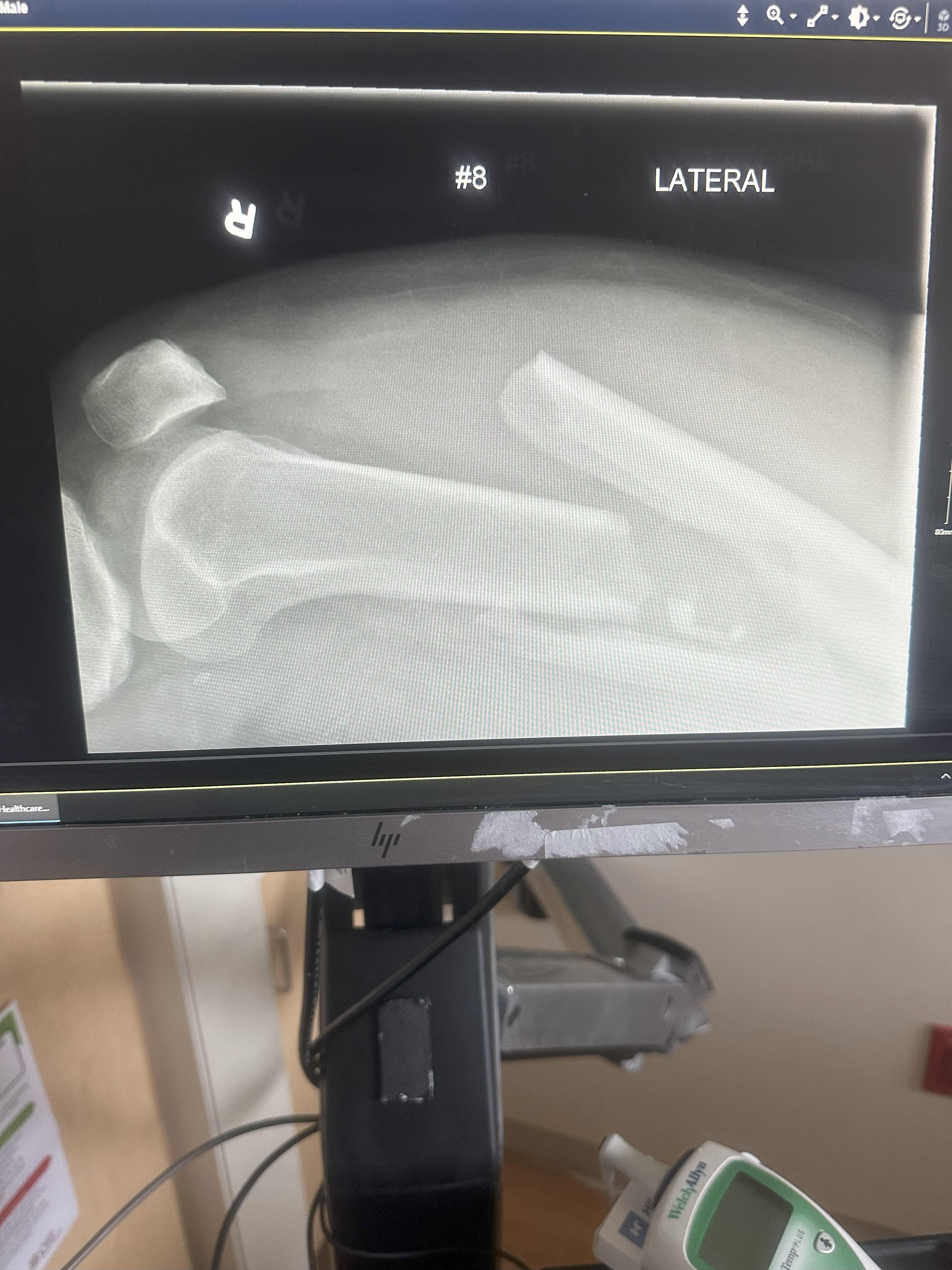 Stand by Chuck: Broken Femur, Long Road Ahead campaign photo, 6 of 7