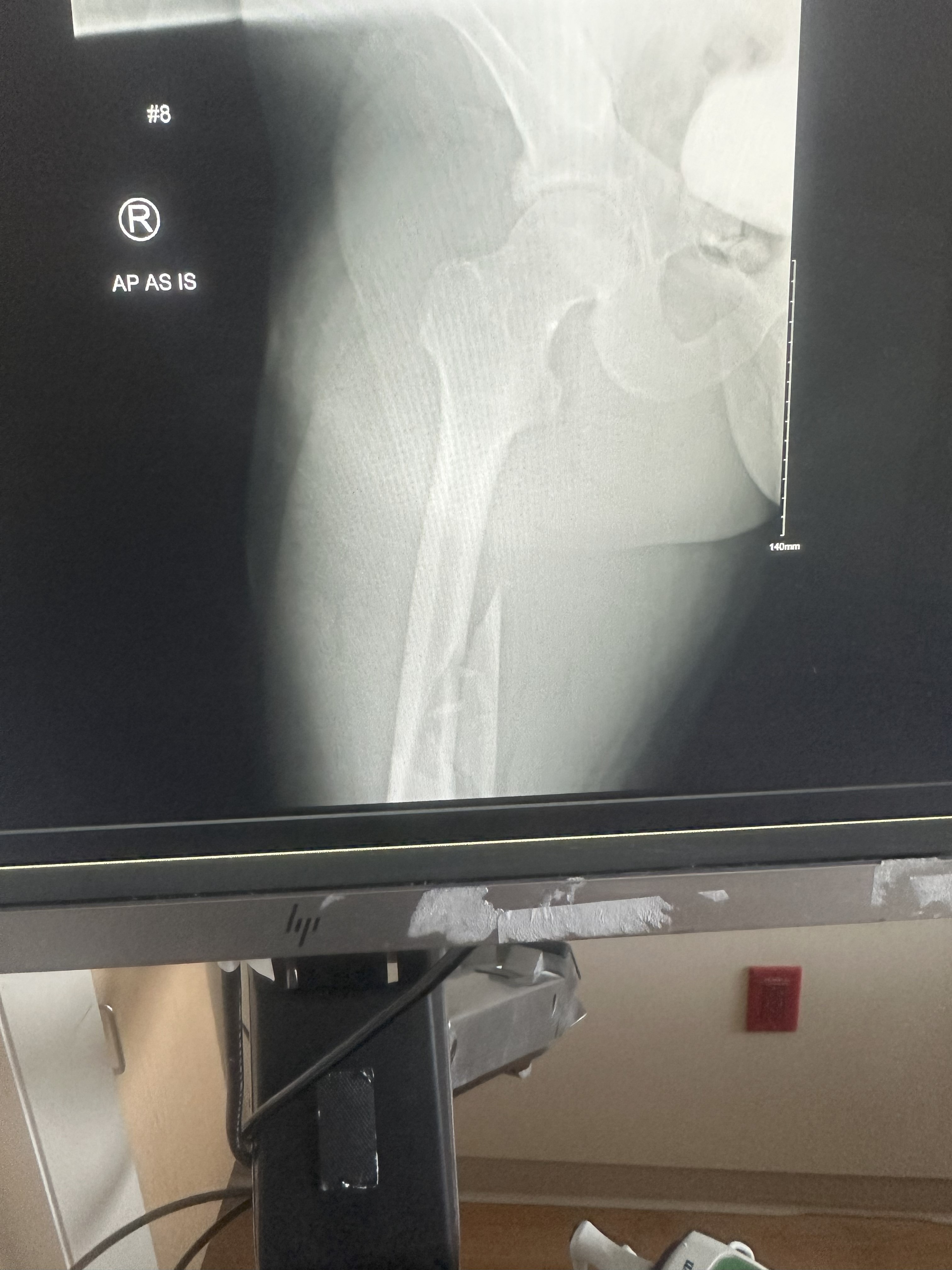 Stand by Chuck: Broken Femur, Long Road Ahead campaign photo, 2 of 7