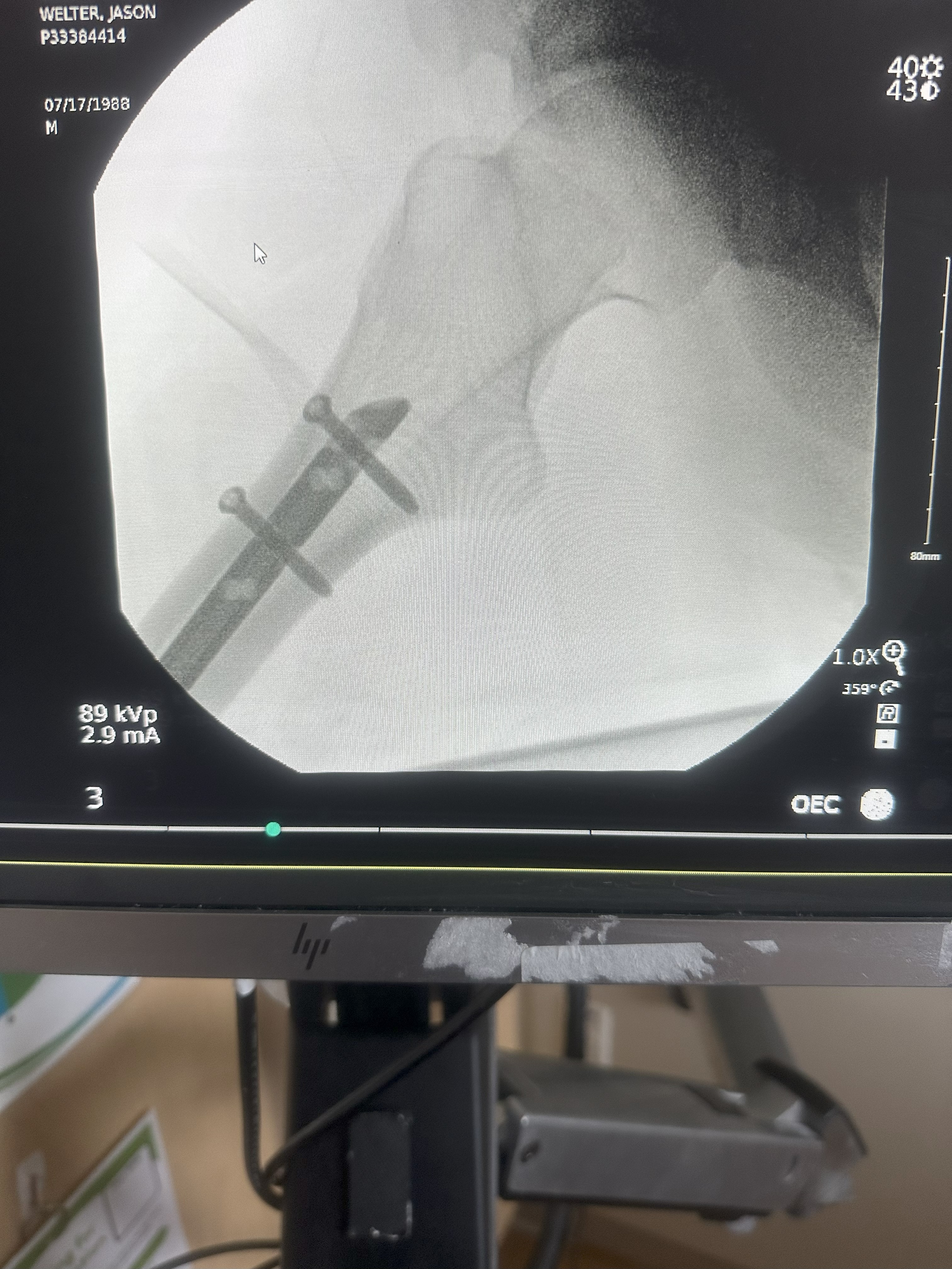 Stand by Chuck: Broken Femur, Long Road Ahead campaign photo, 4 of 7