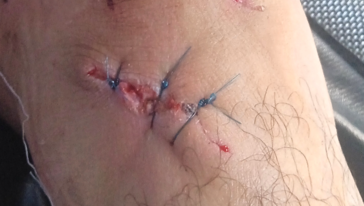 I was injured by shrapnel and urgently need medical treatmen photo
