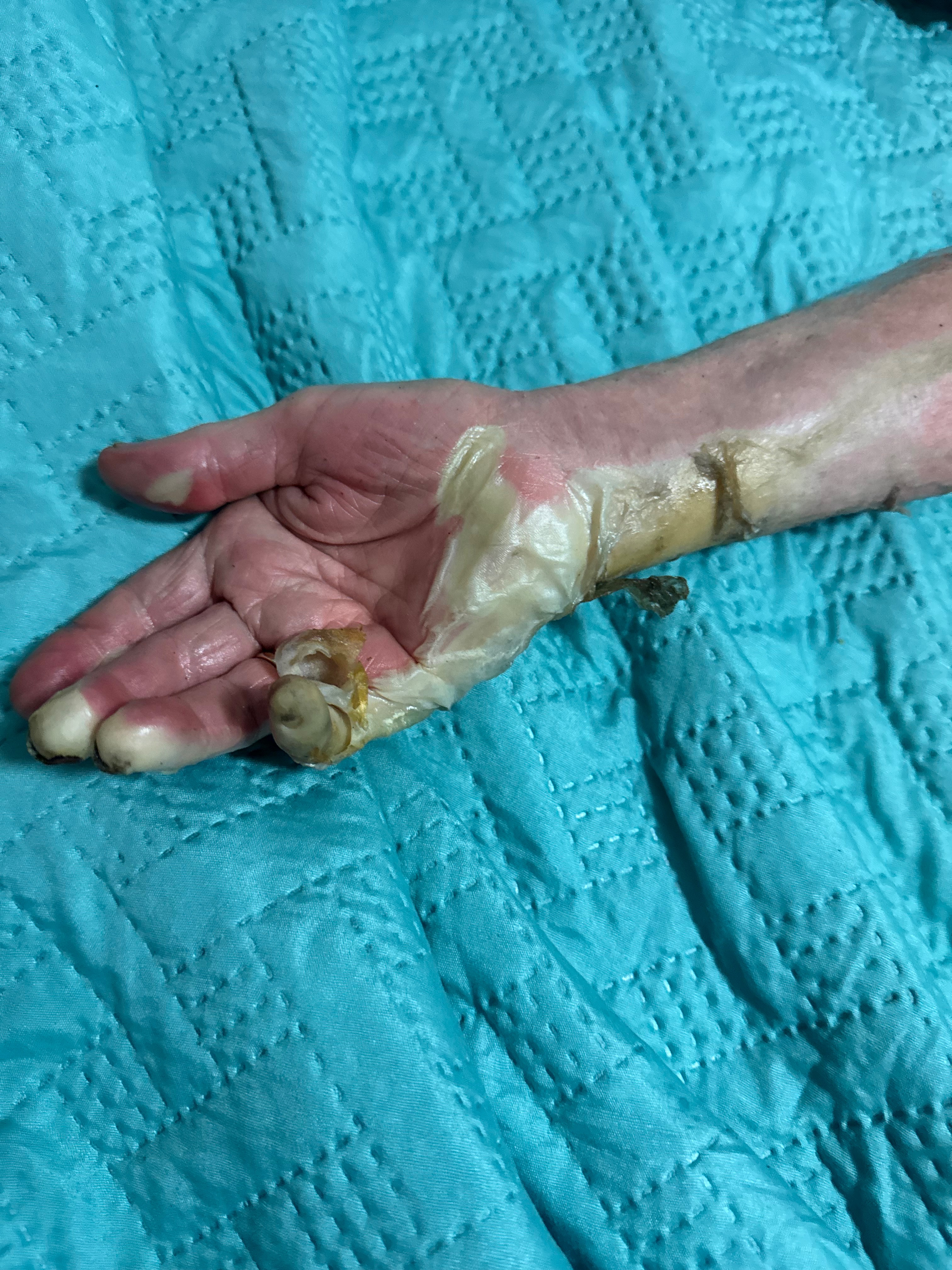 Help Nereida Solivan Heal After Devastating Burn Accident campaign photo, 2 of 7