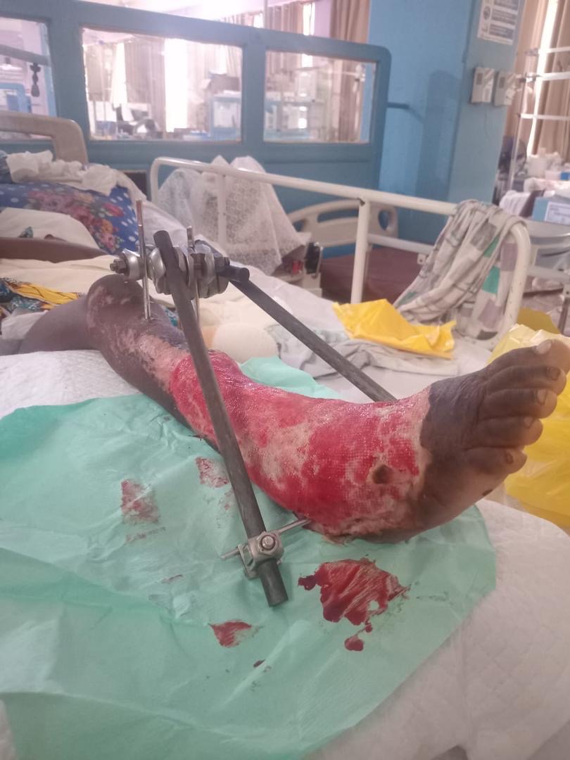 Help Save 6-Year-Old's Life and Leg campaign photo, 6 of 7