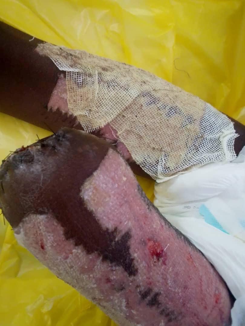 Help Save 6-Year-Old's Life and Leg campaign photo, 4 of 7