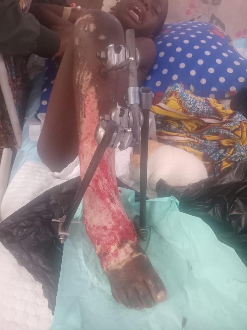 Help Save 6-Year-Old's Life and Leg campaign photo, 5 of 7