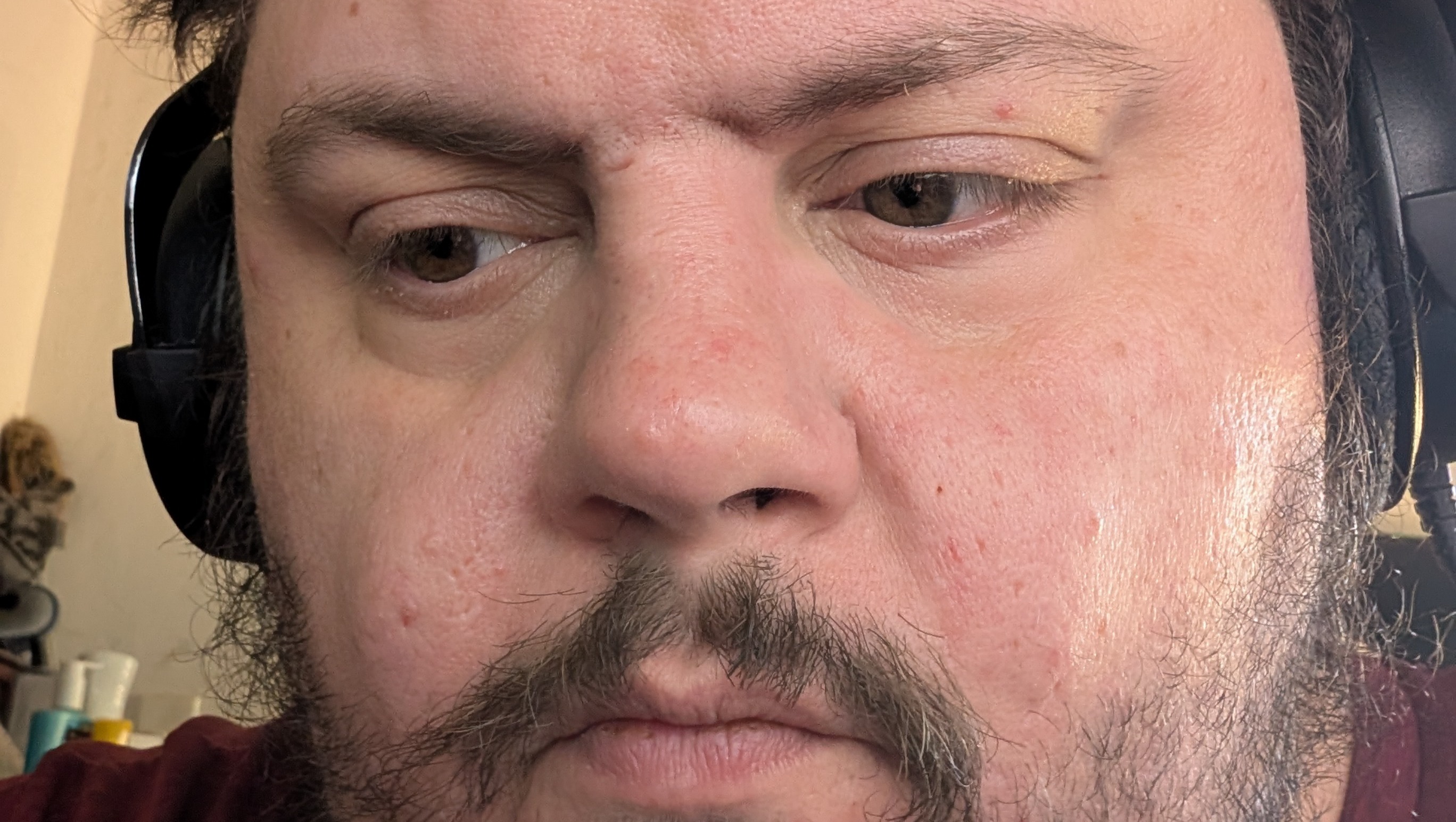 Help Us Battle Severe Hidradenitis Suppurativa