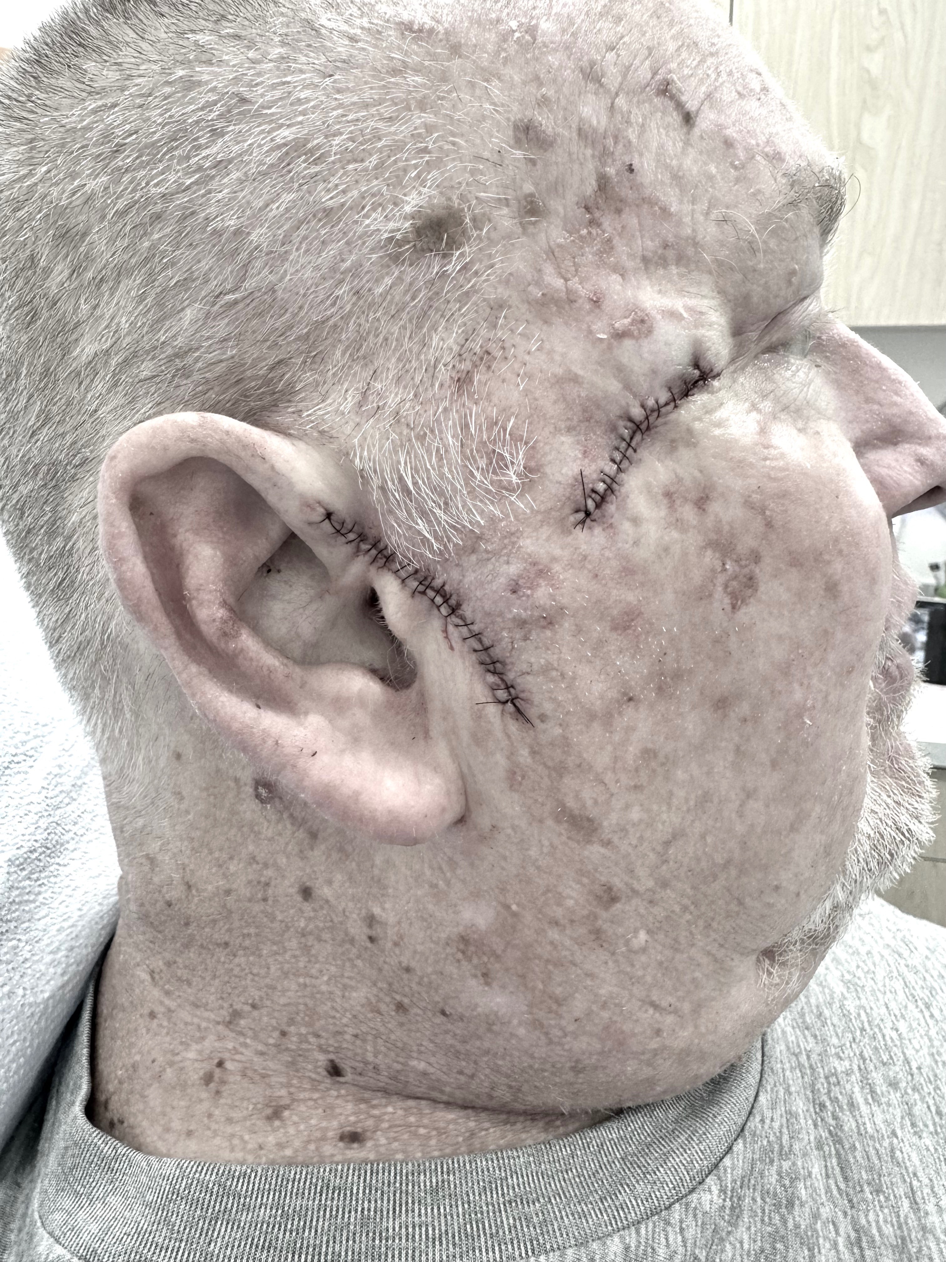 Help Fred Fight Cancer-Support Surgery and Recovery Costs. campaign photo, 5 of 8