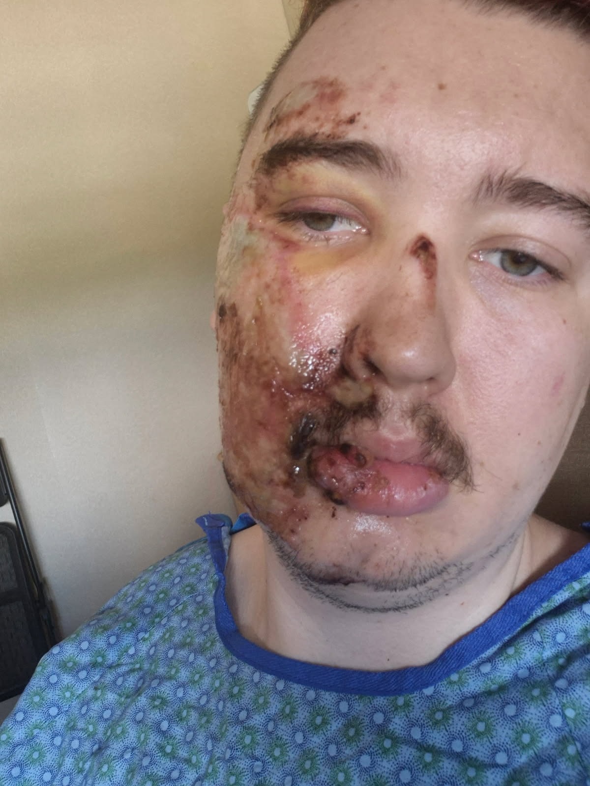 Help Needed: Motorcycle Accident Recovery campaign photo, 5 of 6