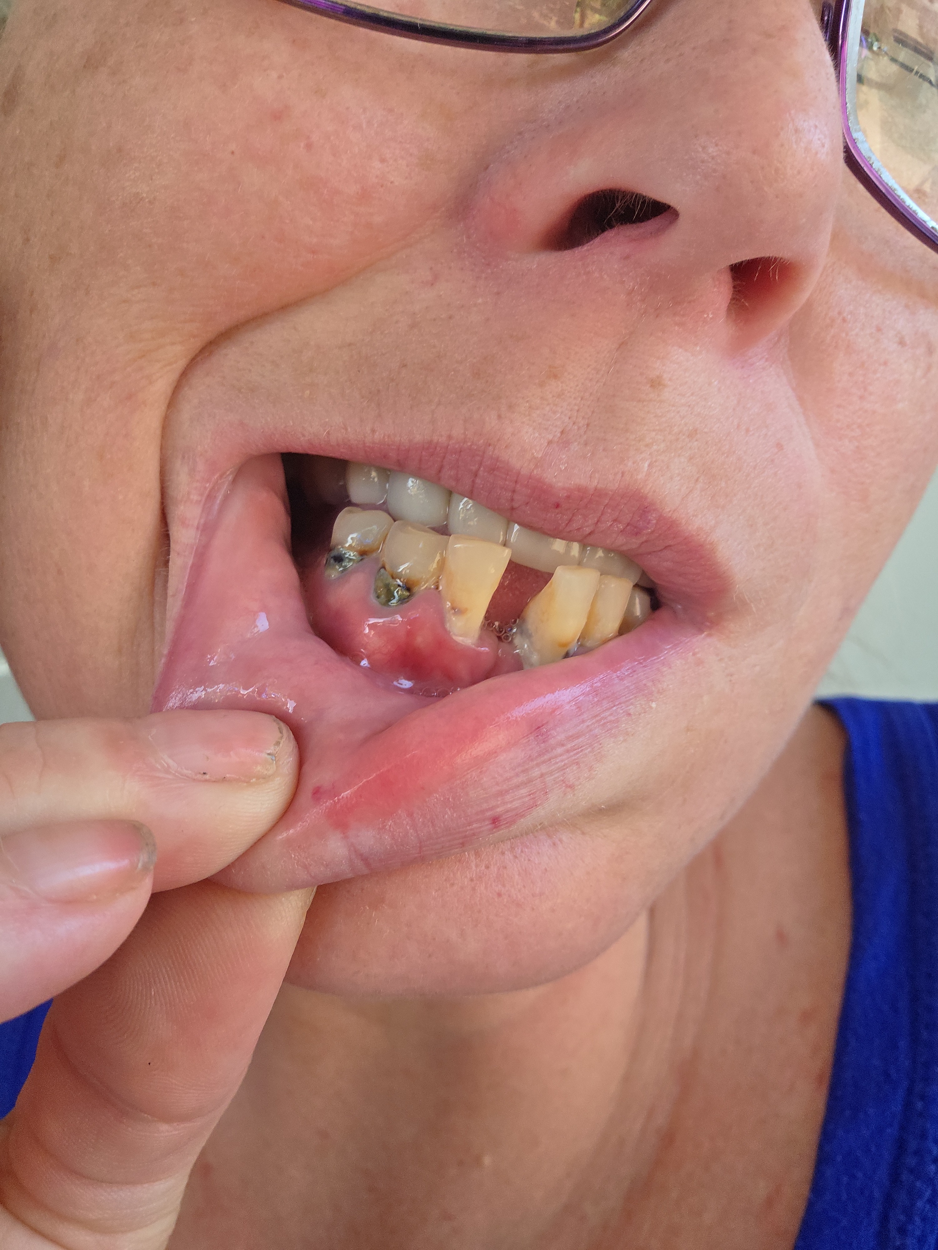 Help Me Smile & Eat Again – Urgent Dental Surgery Needed campaign photo, 4 of 6