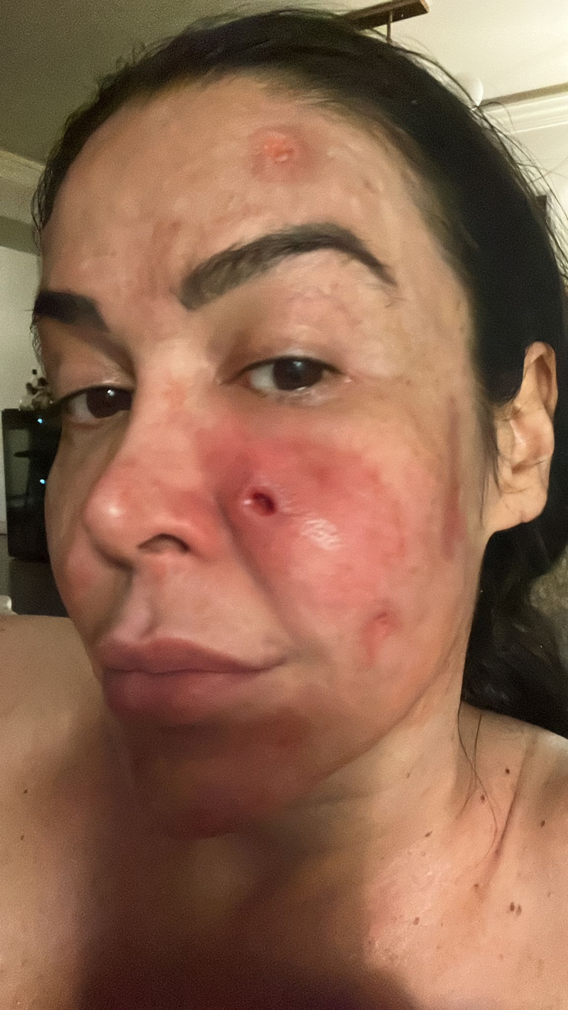 Donate to help me recovery my skin and come back to work! campaign photo, 5 of 8