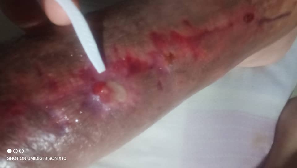 URGENT: Help me save my leg and my life campaign photo, 7 of 8